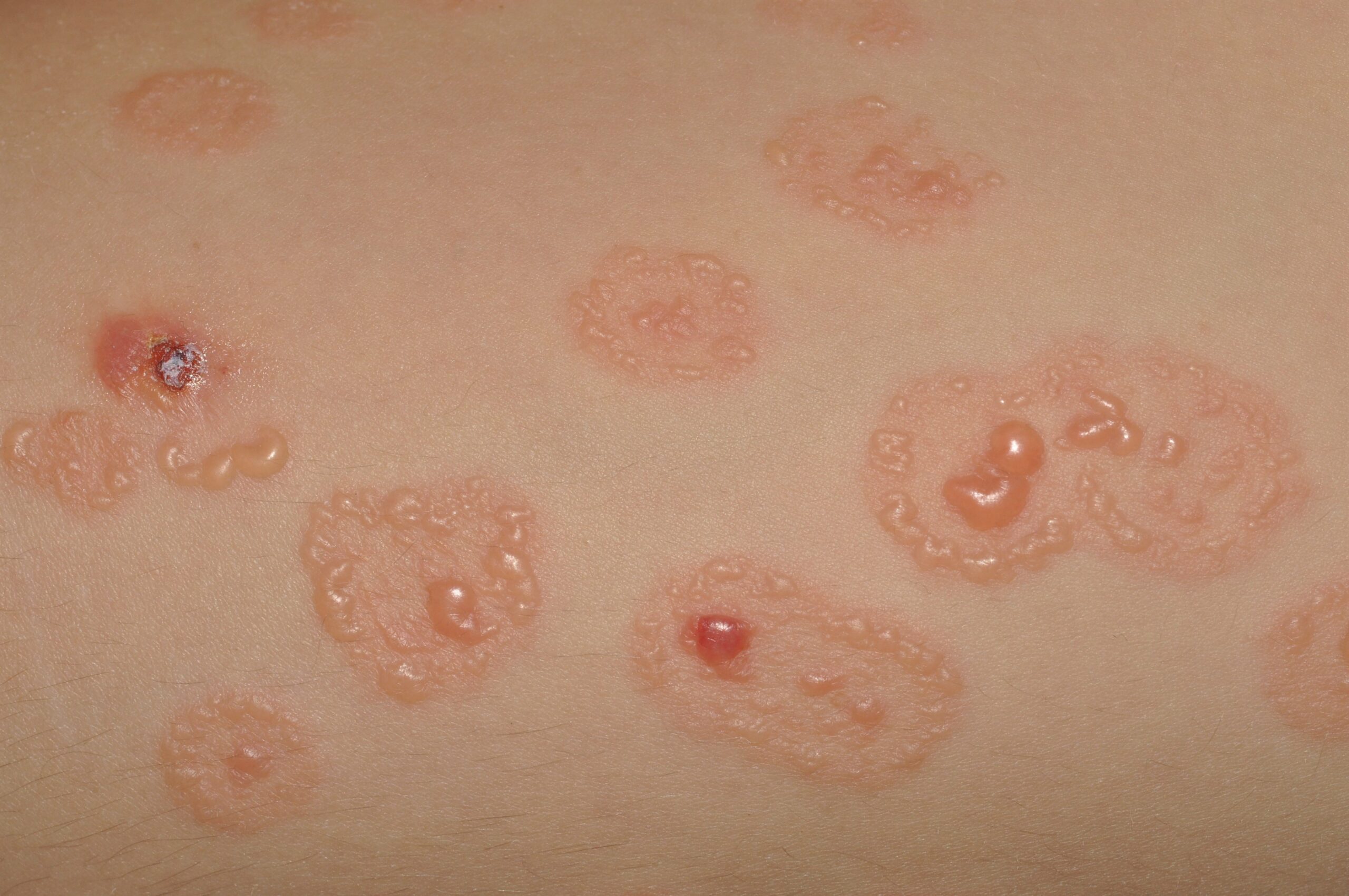 Dermatosis ampollosa cr&oacute;nica benigna infantil (DACBI) L13.8; lesiones ampollosas dispuestas en forma de rosetas, sobre piel normal y eritematosa (3)