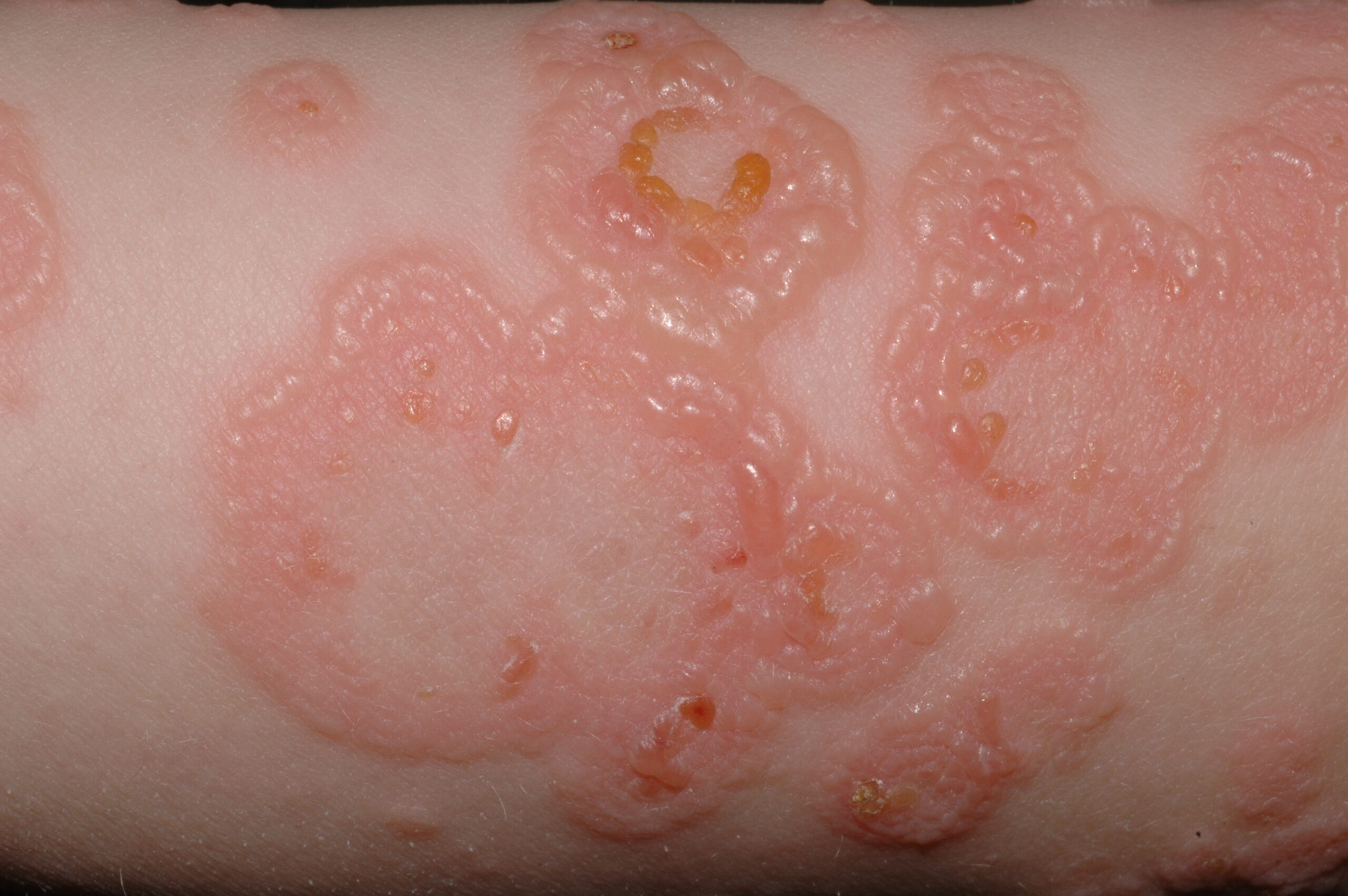 Dermatosis ampollosa cr&oacute;nica benigna infantil (DACBI) L13.8; lesiones ampollosas dispuestas en forma de rosetas, sobre piel normal y eritematosa (6)