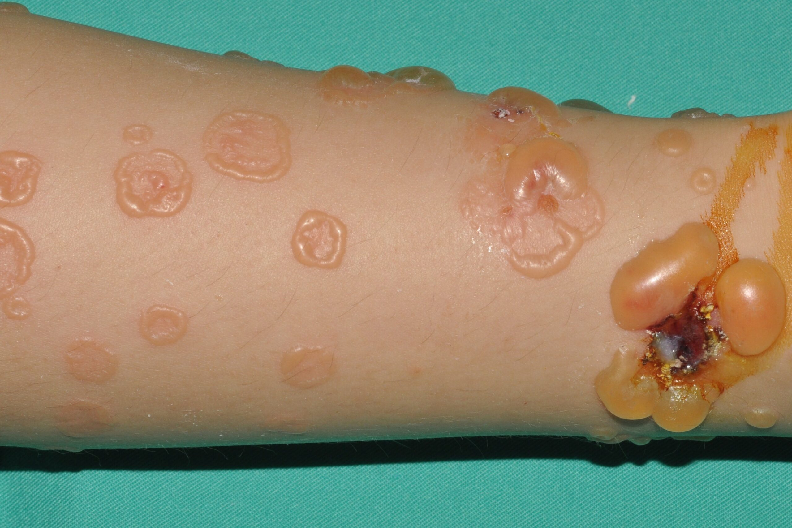 Dermatosis ampollosa cr&oacute;nica benigna infantil (DACBI) L13.8; lesiones ampollosas generalizadas. Evoluci&oacute;n 1 mes (2)