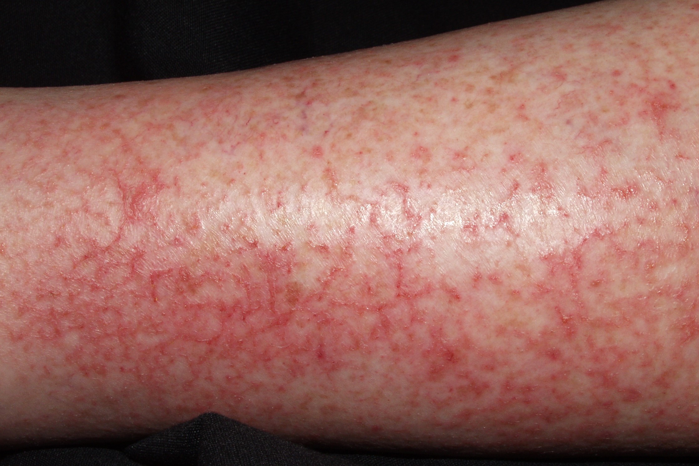 Eczema craquelé L30.81; fase crónica; piel fisurada que forma figuras craqueladas, con exudación (1)