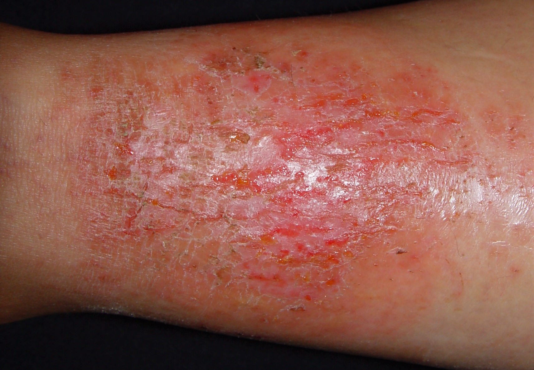 Eczema craquelé L30.81; fase subaguda; piel fisurada que forma figuras craqueladas, con exudación (2)