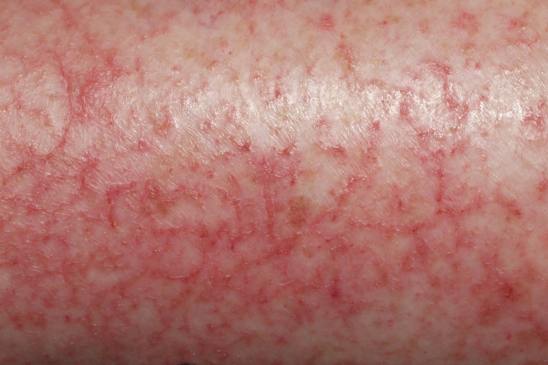 Eczema craquelé L30.81; piel fisurada que forma figuras craqueladas, con exudación (1)