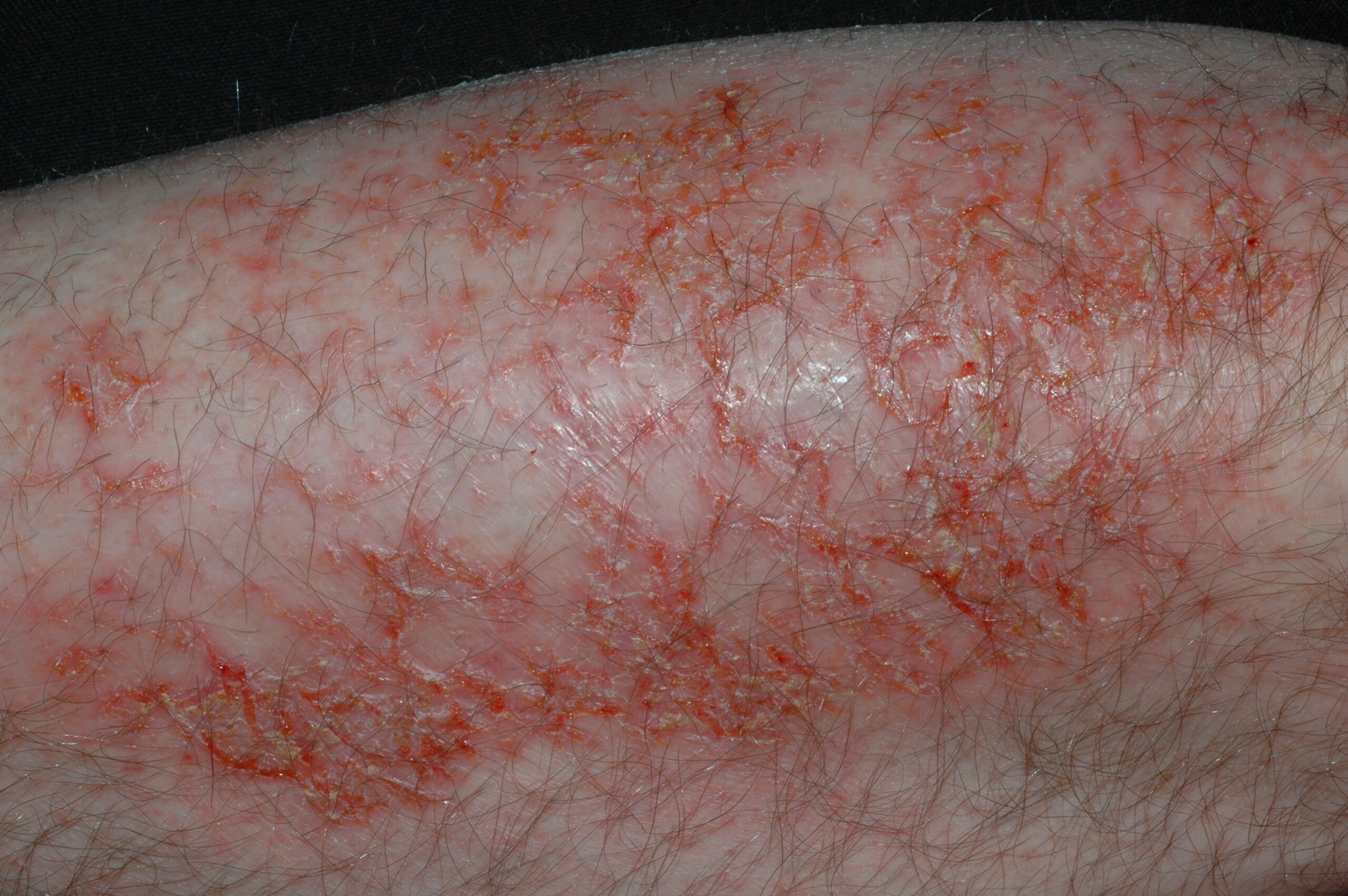 Eczema craquelé L30.81; piel fisurada que forma figuras craqueladas, con exudación (7)
