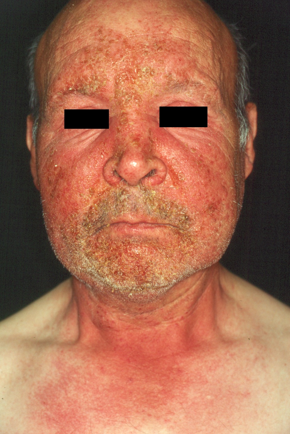 Eczema fotoalérgico L56.1; eritema, descamación y prurito intenso después de aplicarse un fotoprotector con benzofenonas y exponerse al sol