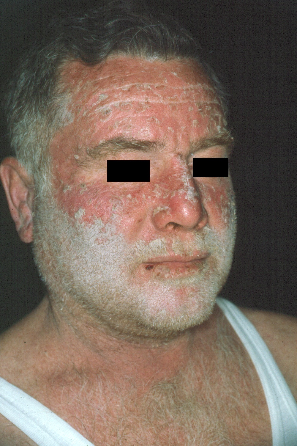 Eczema fotoalérgico L56.1; eritema, descamación y prurito intenso después de la toma de ketoprofeno1 (1)