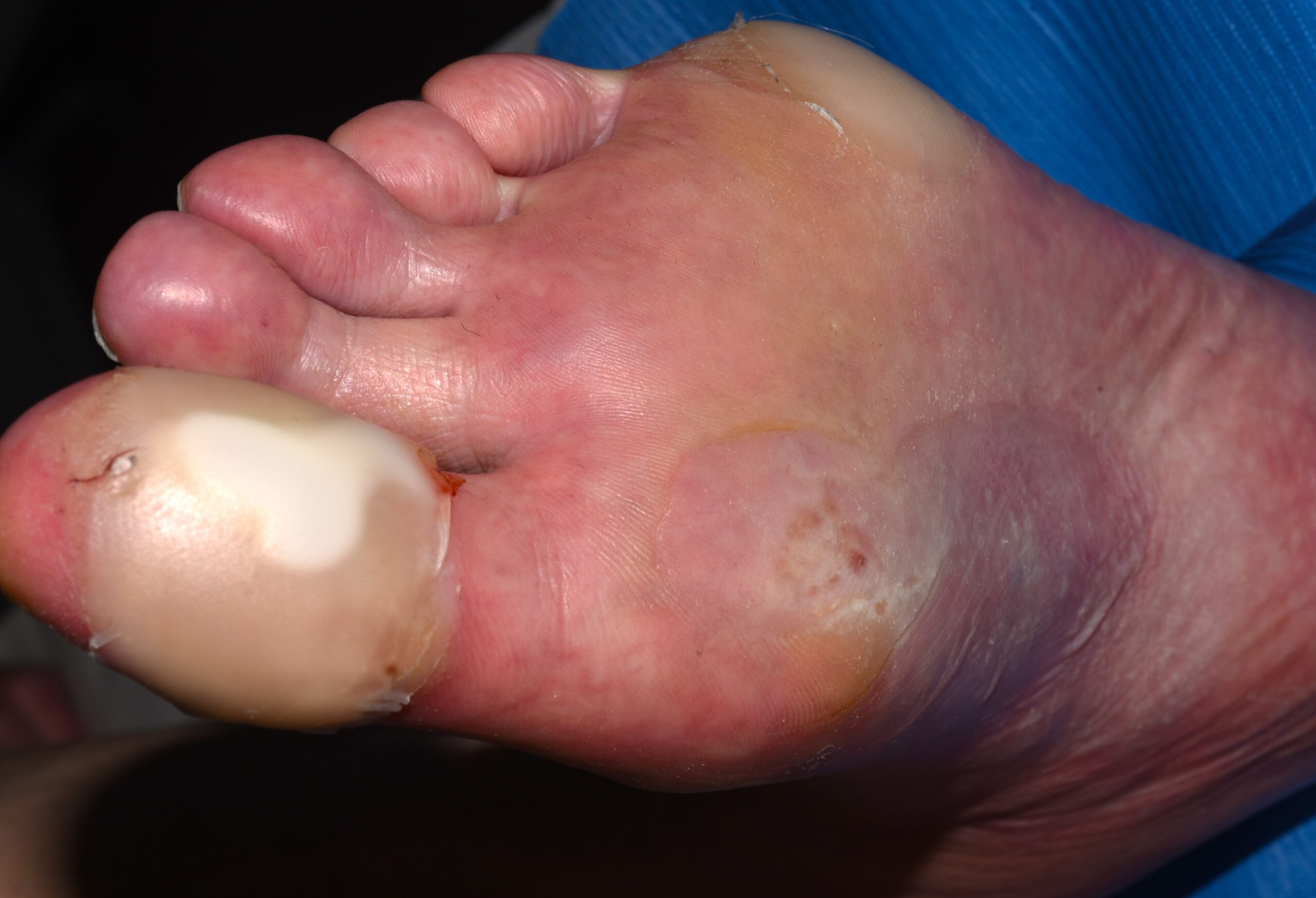 Epidermolisi ampollosa adquirida (EBA) L12.30; ampollas a tensi&oacute;n en zonas de roce (1)