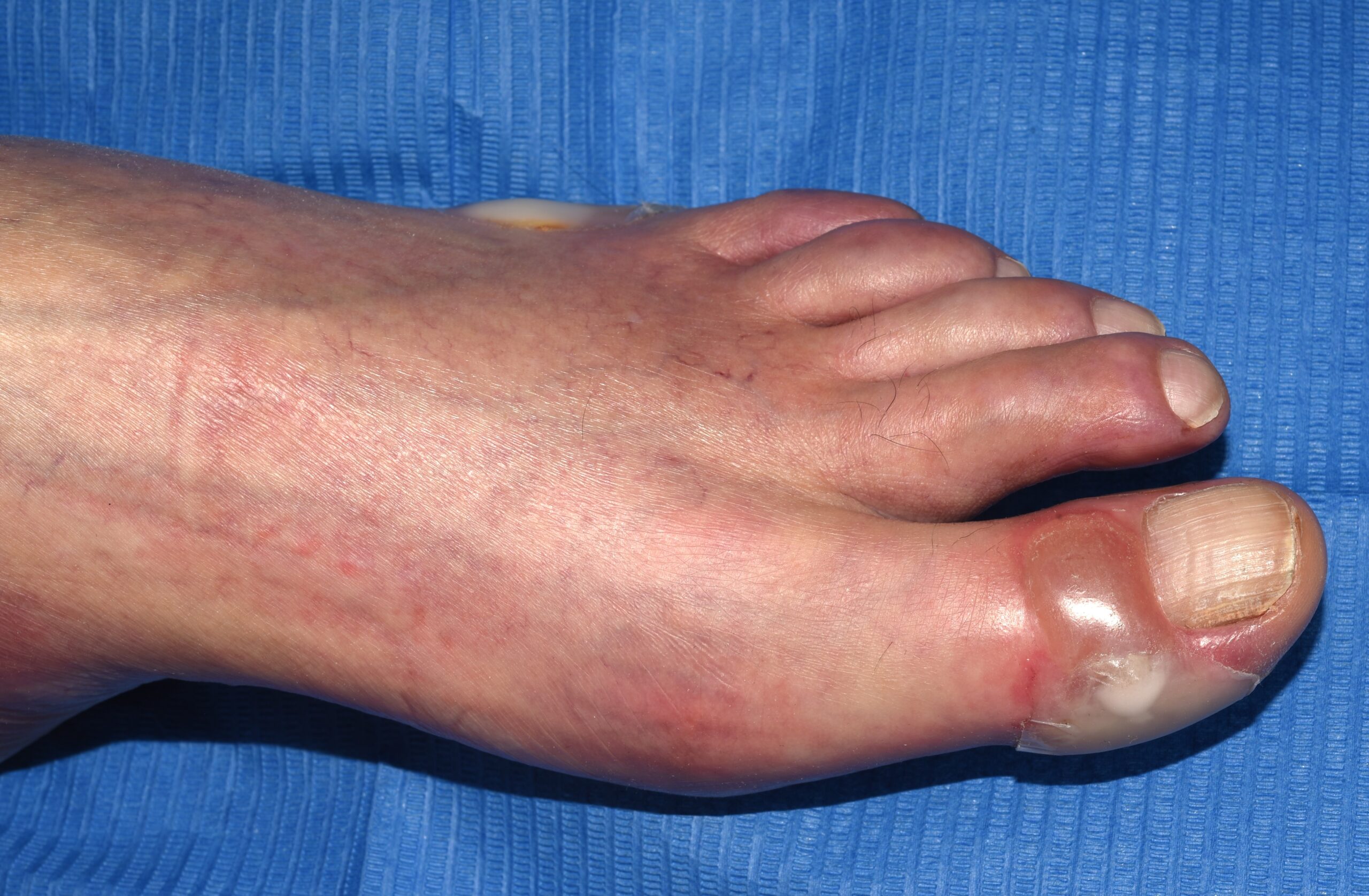 Epidermolisi ampollosa adquirida (EBA) L12.30; ampollas a tensi&oacute;n en zonas de roce1 (2)
