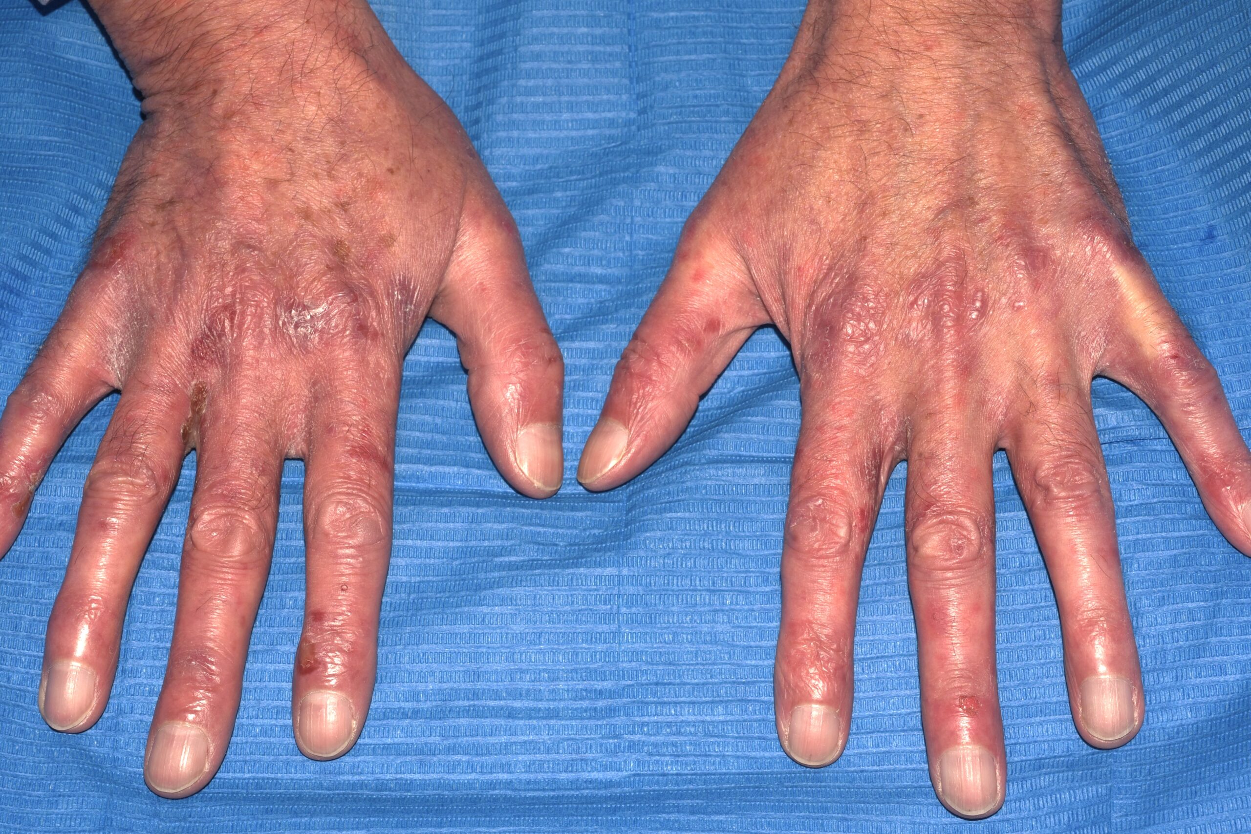 Epidermolisi ampollosa adquirida (EBA) L12.30; erosiones en zonas de roce y quistes de millium (1)