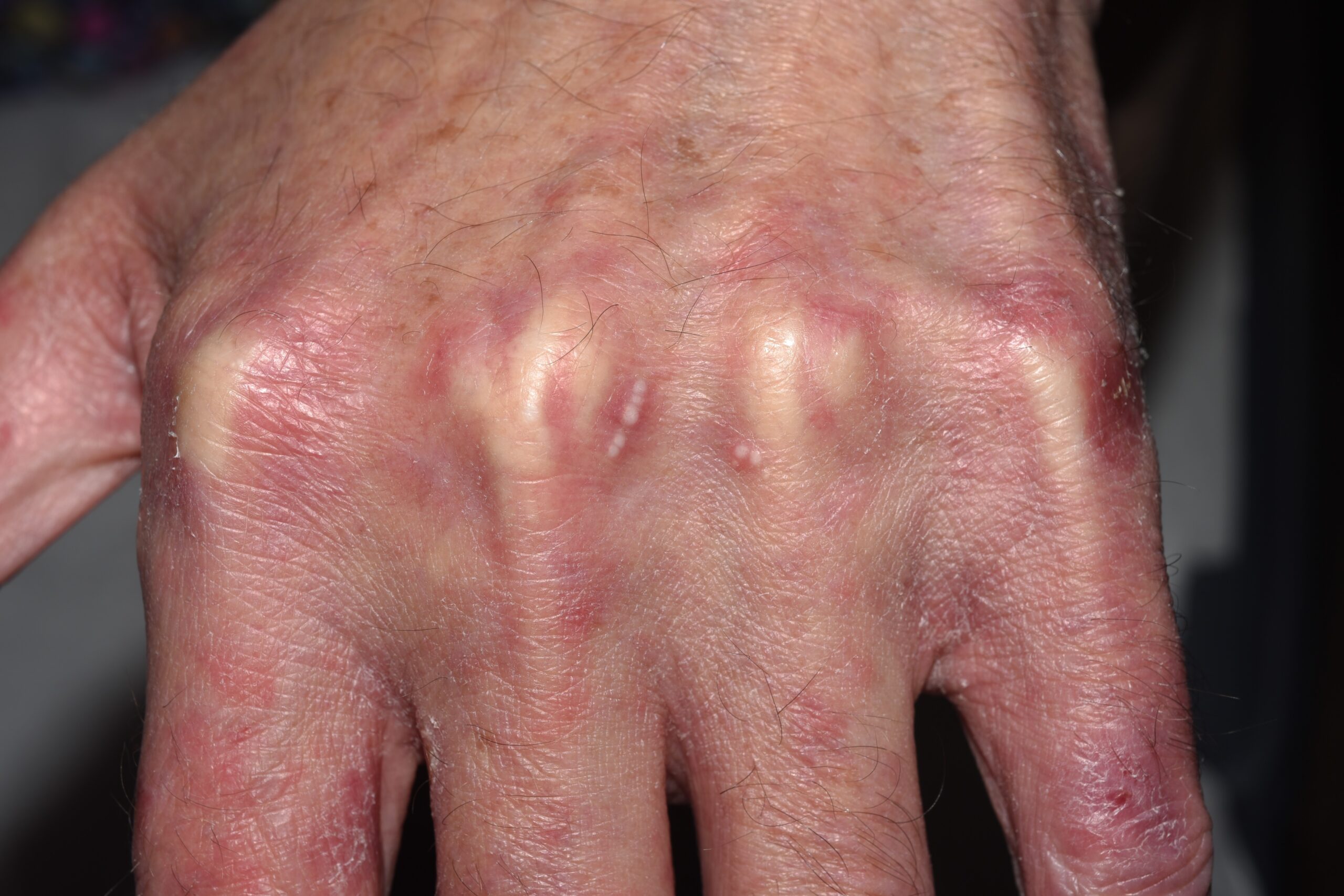 Epidermolisi ampollosa adquirida (EBA) L12.30; erosiones en zonas de roce y quistes de millium (3)