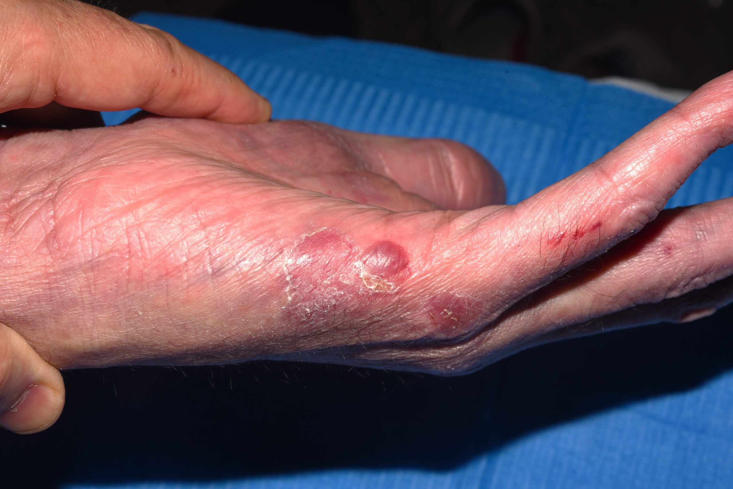 Epidermolisi ampollosa adquirida (EBA) L12.30; erosiones y ampollas a tensi&oacute;n en zonas de roce
