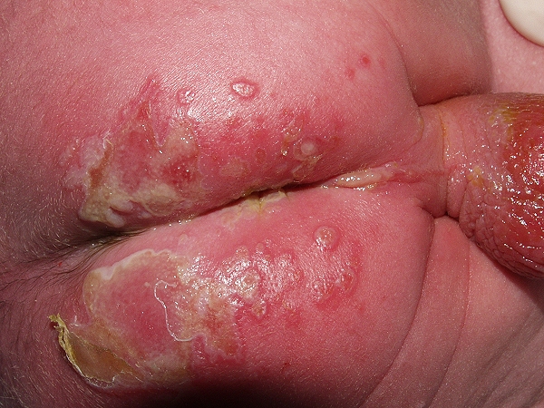 Epidermolisis ampollosa juntural tipo Herlitz Q81; erosiones generalizadas de evoulci&oacute;n t&oacute;rpida (11)