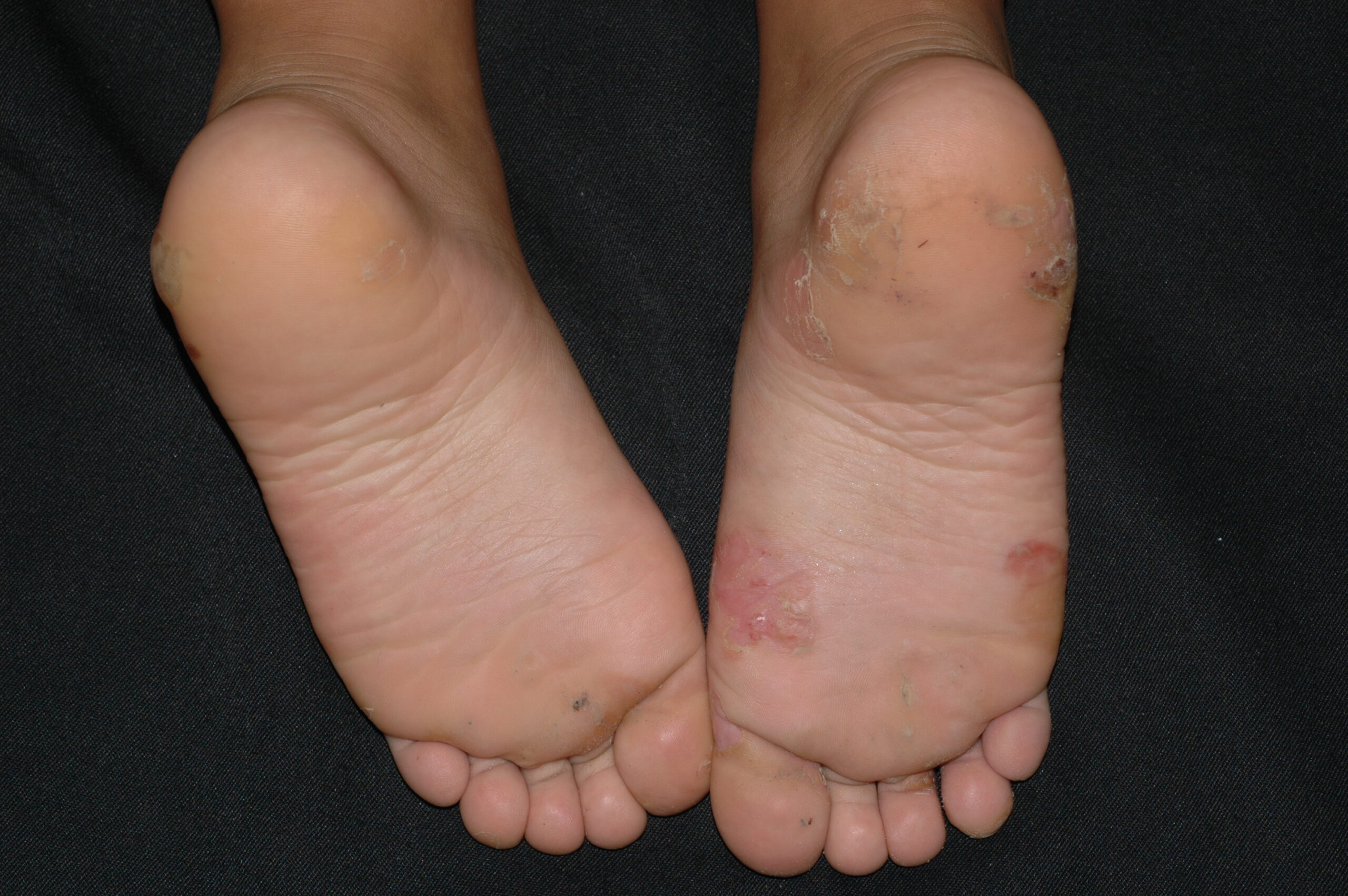 Epidermolisis ampollosa simple palmoplantar de Weber-Cockayne Q81; ampollas en la planta de los pies al comenzar a caminar (3)