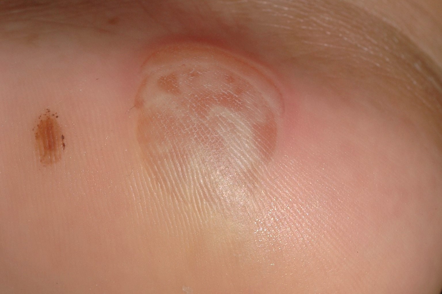 Epidermolisis ampollosa simple palmoplantar de Weber-Cockayne Q81; ampollas en la planta de los pies al comenzar a caminar