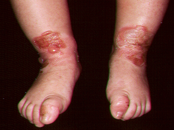 Epidermolisis ampollosa simple tipo Dowling-Meara Q81; erosoines y ampollas en la regi&oacute;n pretibial inferior en la zona de presi&oacute;n para provacar el llanto