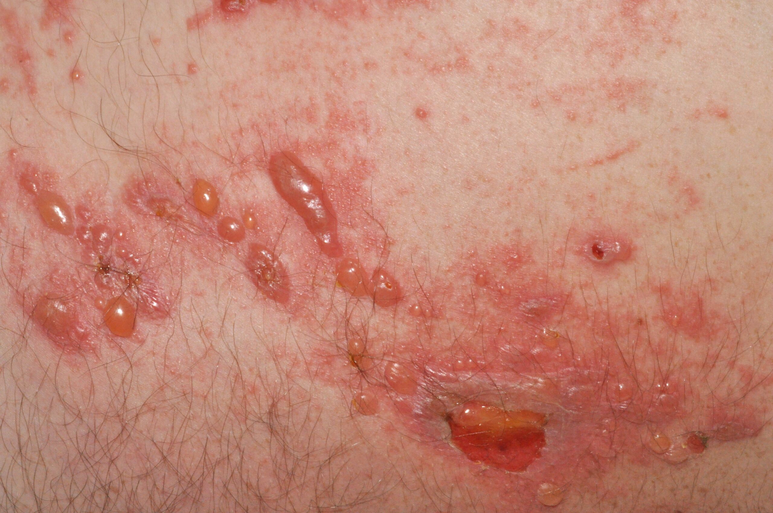 Fitofotodermatitis L57.8; placas eritematoedematosas con vesículas y ampollas que siguen trayactos lineales (2)