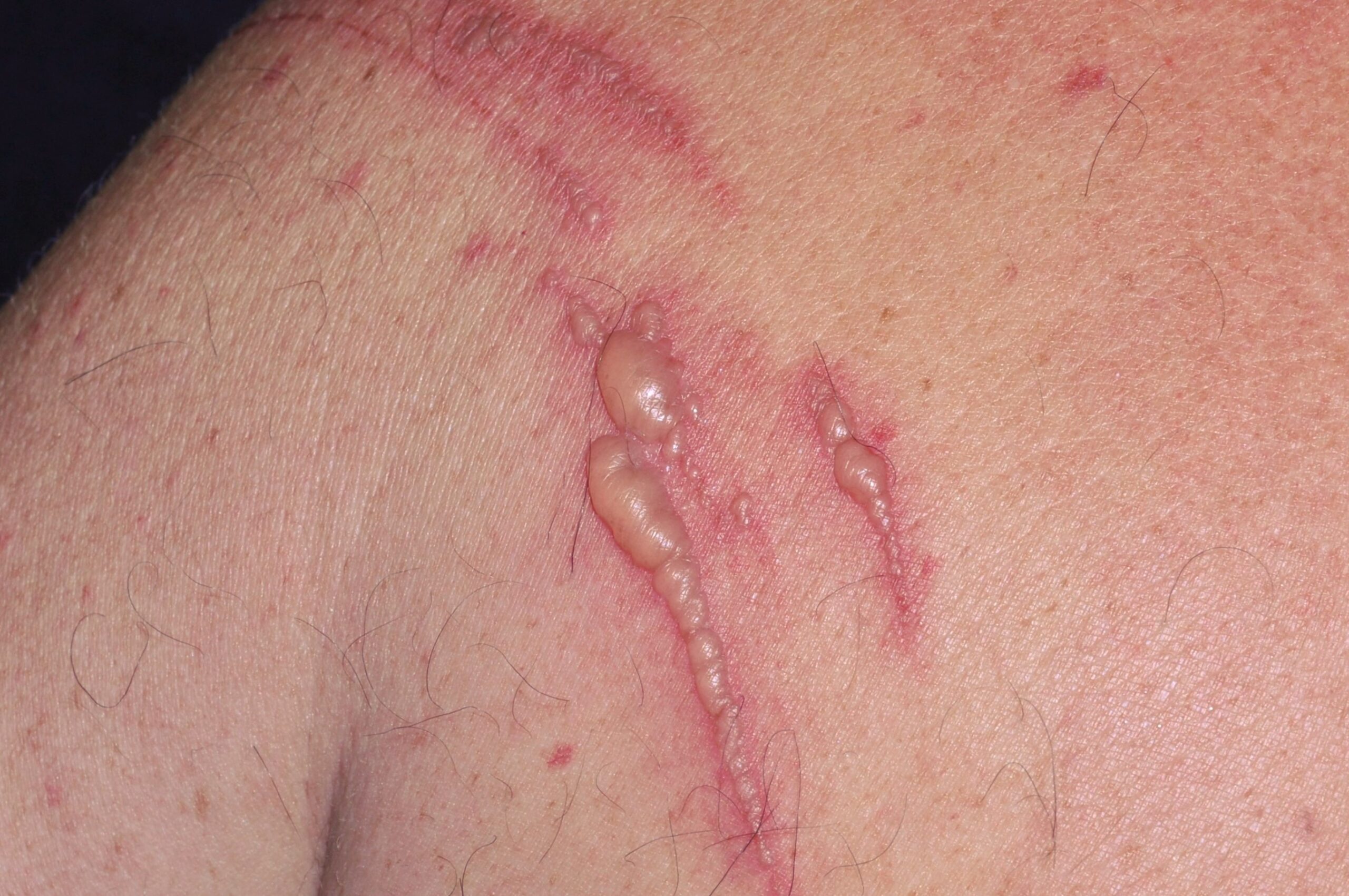 Fotofitodermatitis L57.8; lesiones eritematosas y vesiculosas lineales en el hombro a las pocas horas de haber estado escalando y posteriormente haberse expuesto inadvertidamente al sol