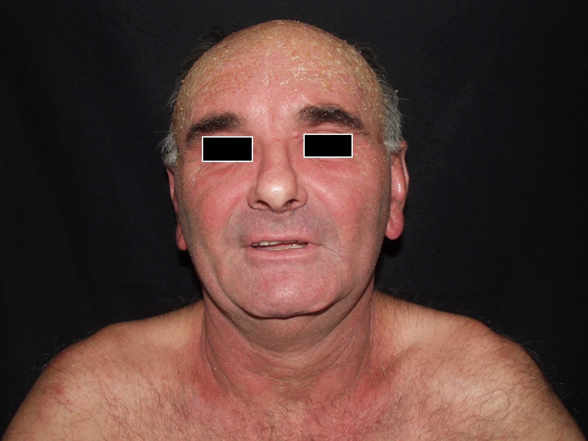 Fototoxicidad por tiacidas L56.0; eritema facial, del cuero cabelludo y la V torácica al cabo de unas horas de tomar un diruético tiacídico1 (1)