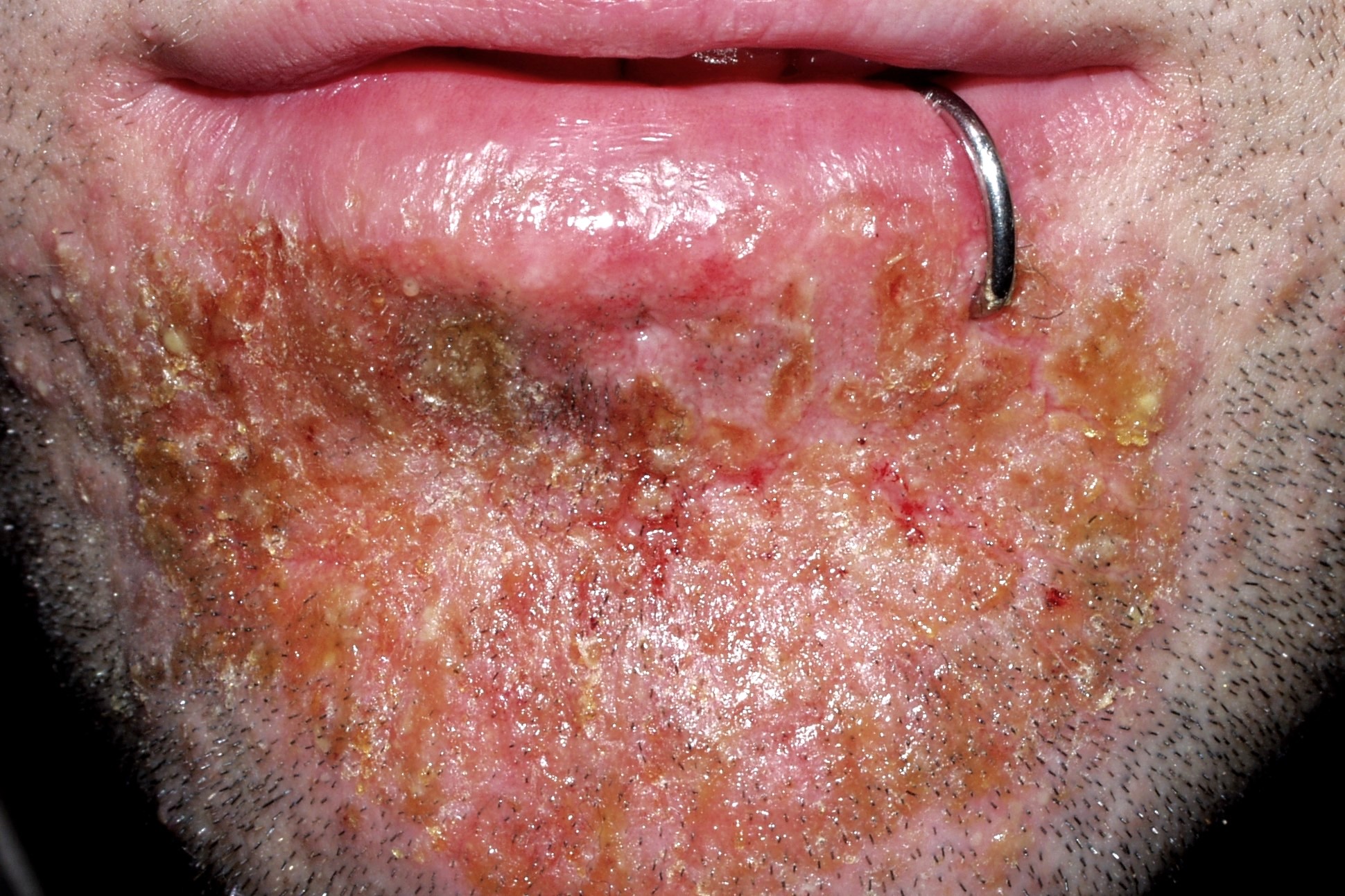 L23.0 Dermatitis alérgica  de contacto por niquel (piercing); fase subaguda; eritema, exudación y escamocostras amarillentas