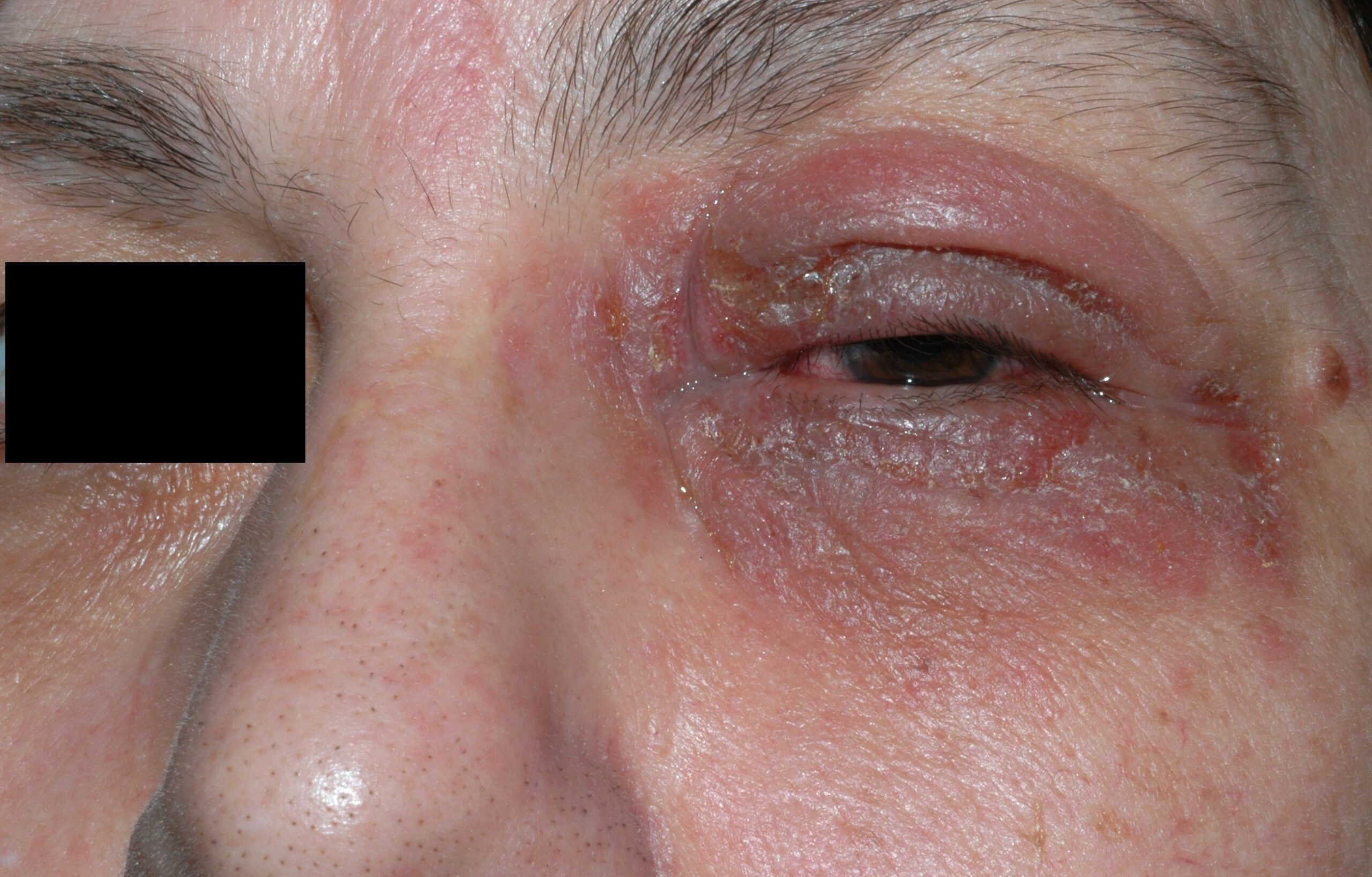 L23.3 Dermatitis alérgica de contacto palpebral por un colirio de ciclofloxacino; eritema, edema, exudación y escamocostras