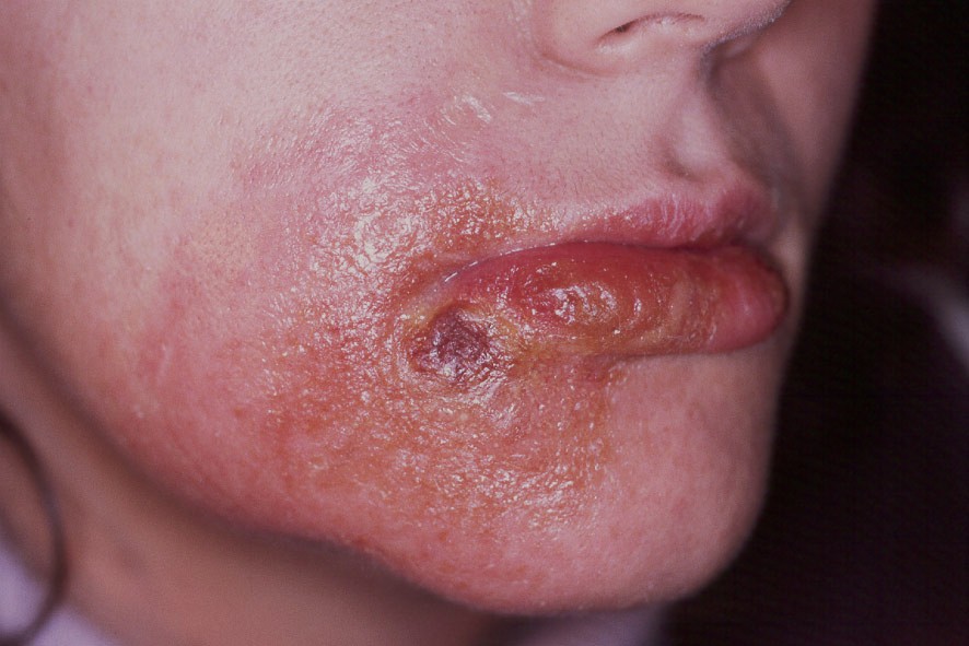 L23.3 Dermatitis alérgica de contacto por tromantadina (antiherpético); eritema, edema, vesículas, exudación y costras amarillentas