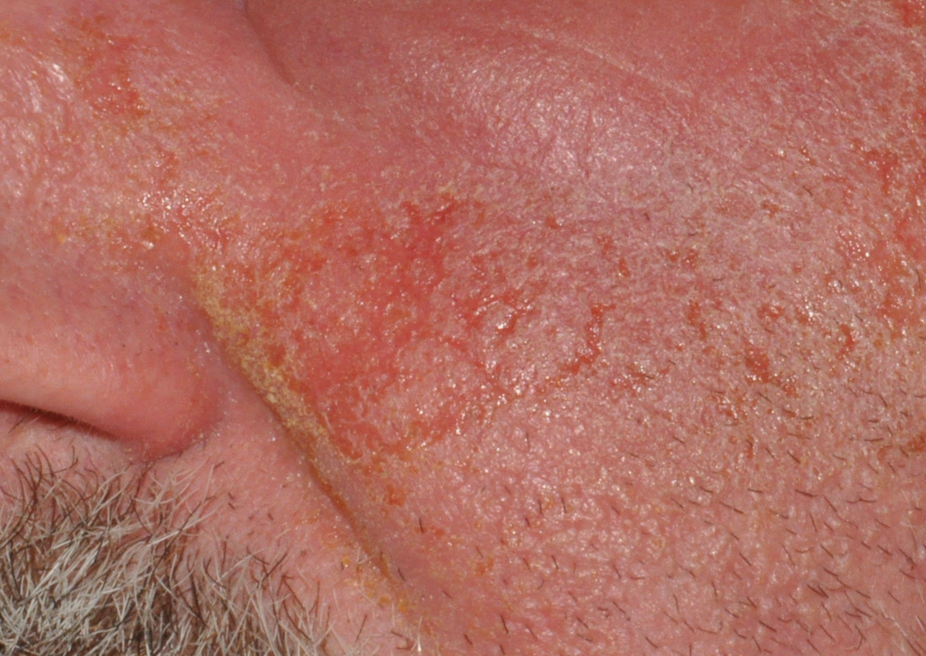 L23.3 dermatitis alérgica de contacto al bálsamo del Perú (aceites perfumados de algunas fragancias); eritema, edema, exudación y escamocostras