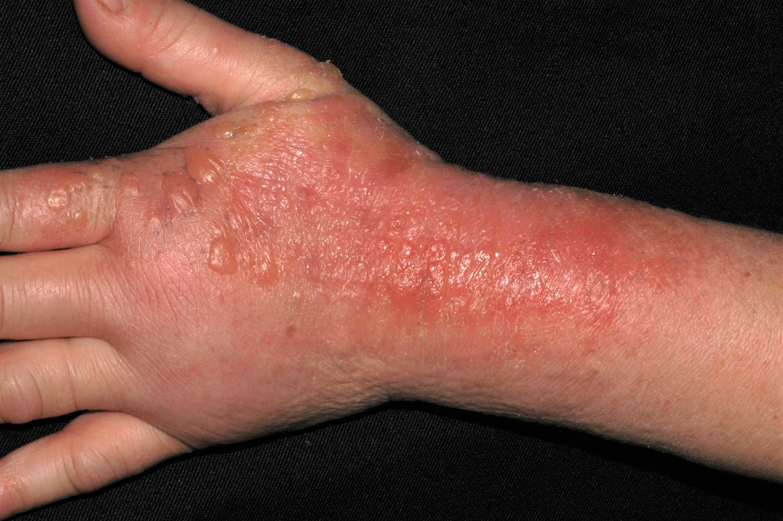L23.3 dermatitis alérgica de contacto por AINEs (piroxicam, fotoalergia); fase aguda; eritema y edema intensos con vesículas y ampollas