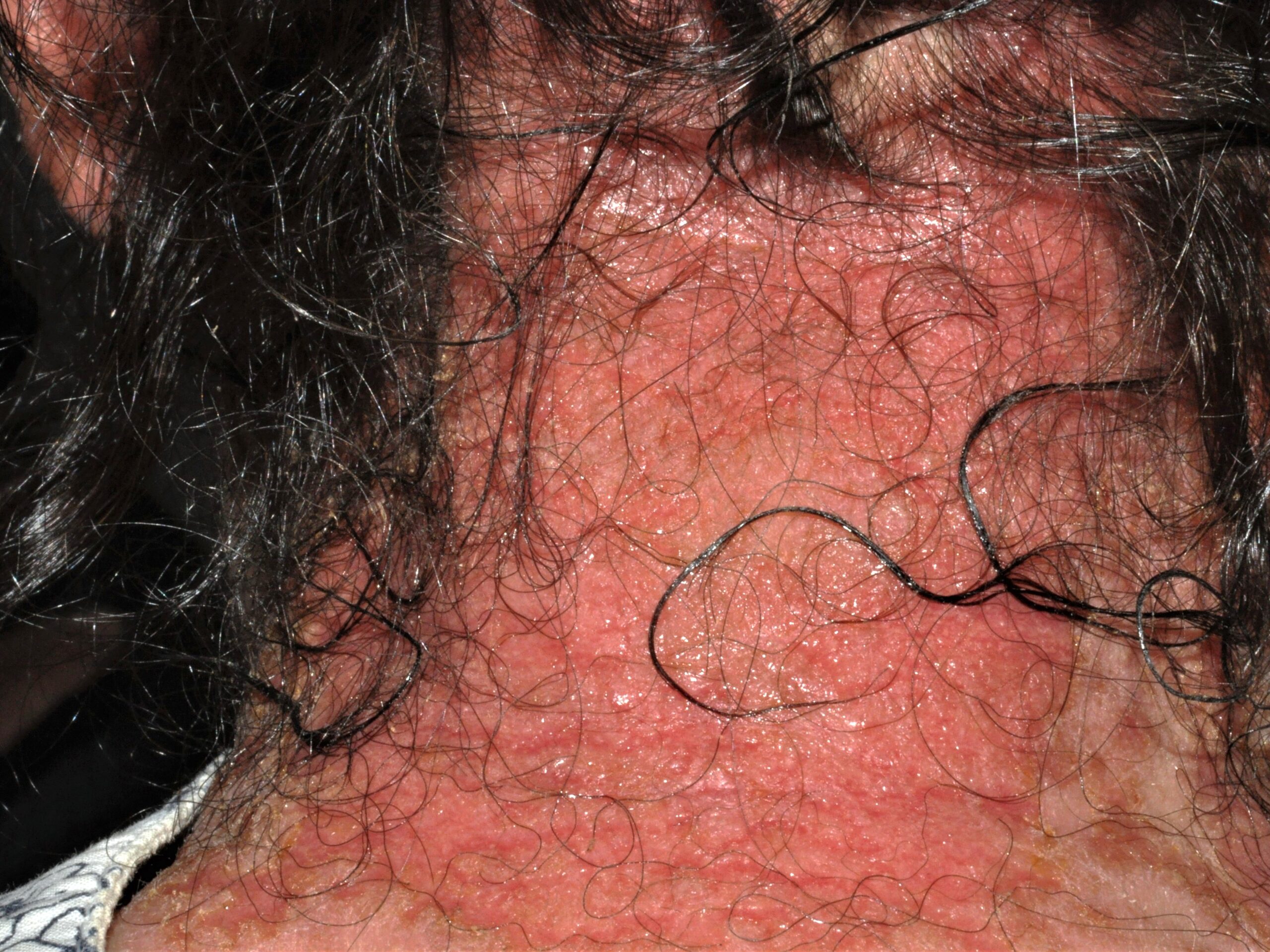 L23.4 dermatitis alérgica de contacto al tinte del cabello (parafinilendiamina); eritema y edema intensos con formacion de vesículas y ampollas y exudación
