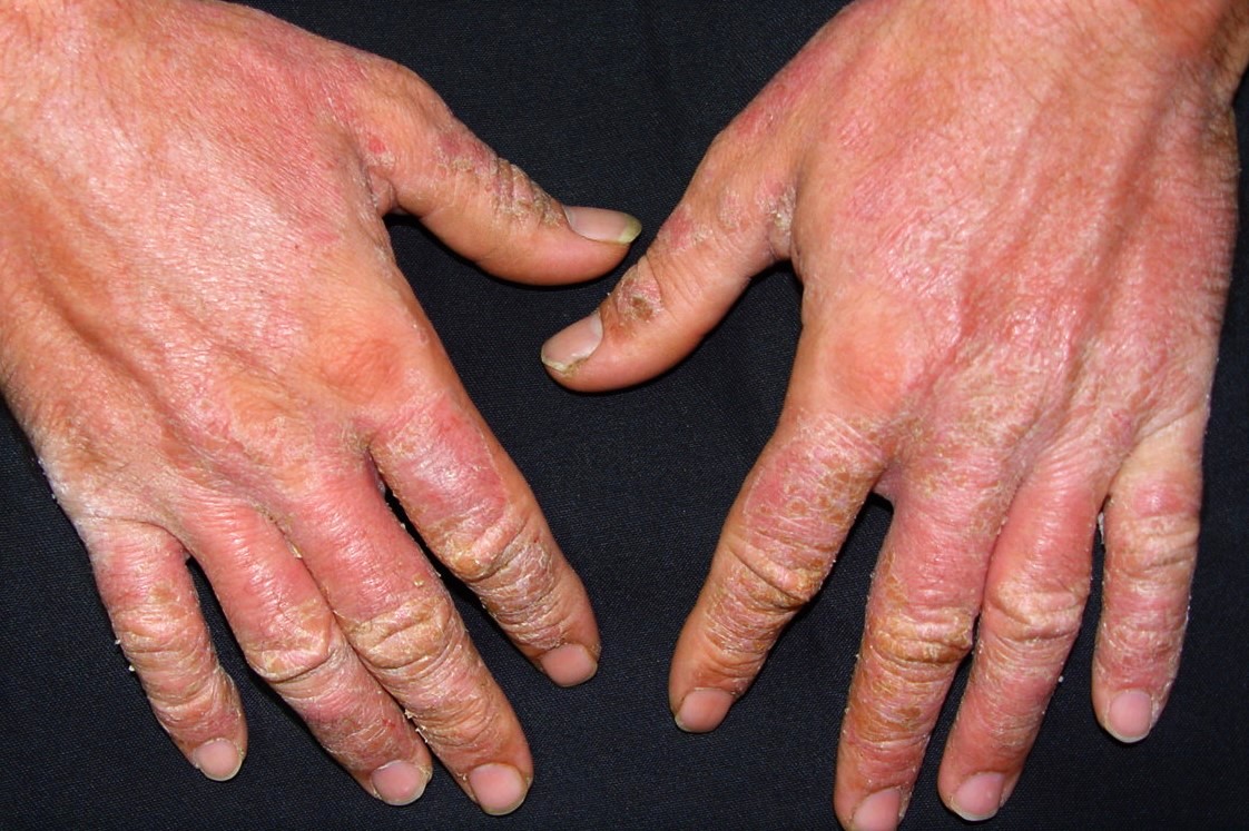 L23.5 Dermatitis alérgica de contacto por cemento (cromo) en un albañil; fase crónica; eritema, edema discreto y descamación (1)