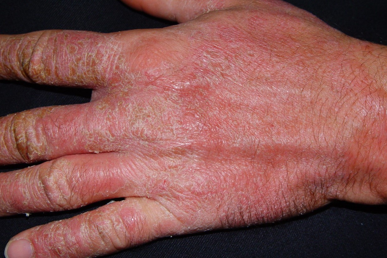 L23.5 Dermatitis alérgica de contacto por cemento (cromo) en un albañil; fase crónica; eritema, edema discreto y descamación (2)