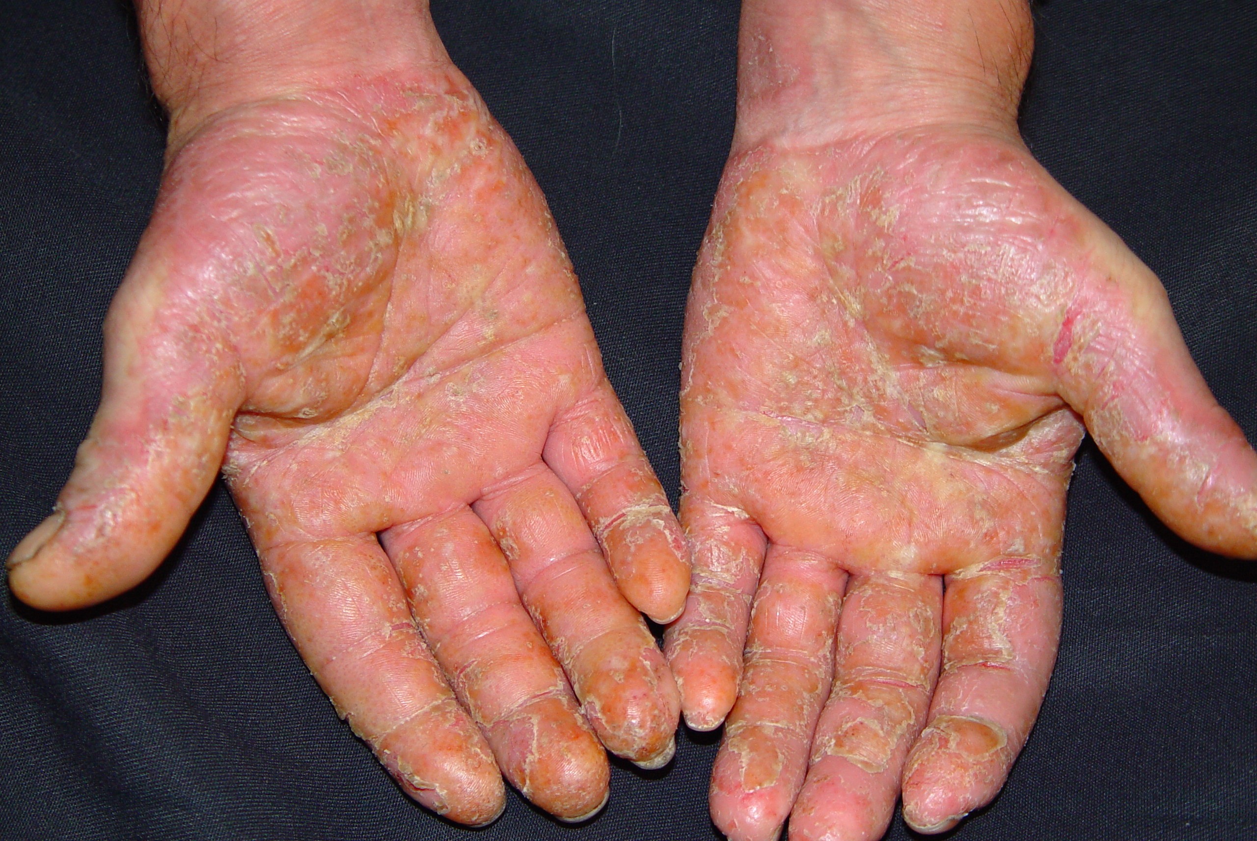 L23.9 Dermatitis alérgica  de contacto por aceites de corte (taladrinas) en un mecánico; fase crónica; eritema, discreto edema y descamación