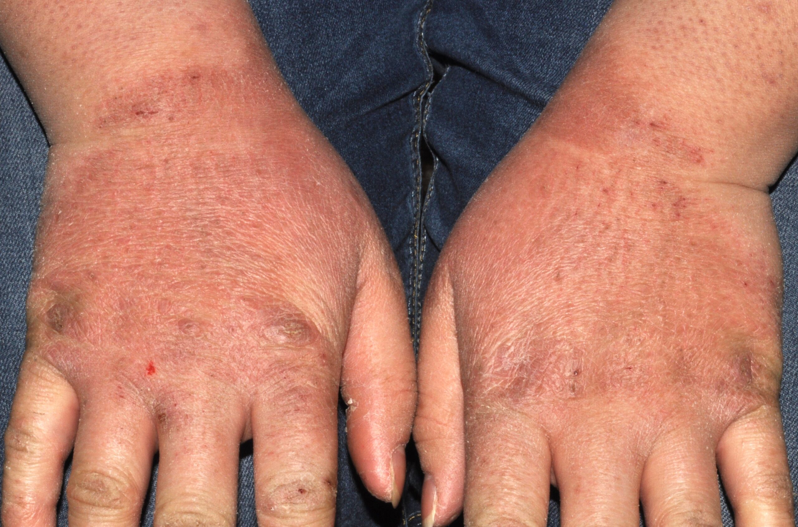 L24 dermatitis irritativa de contacto por agua y frio (manos cortadas), dorso de manos