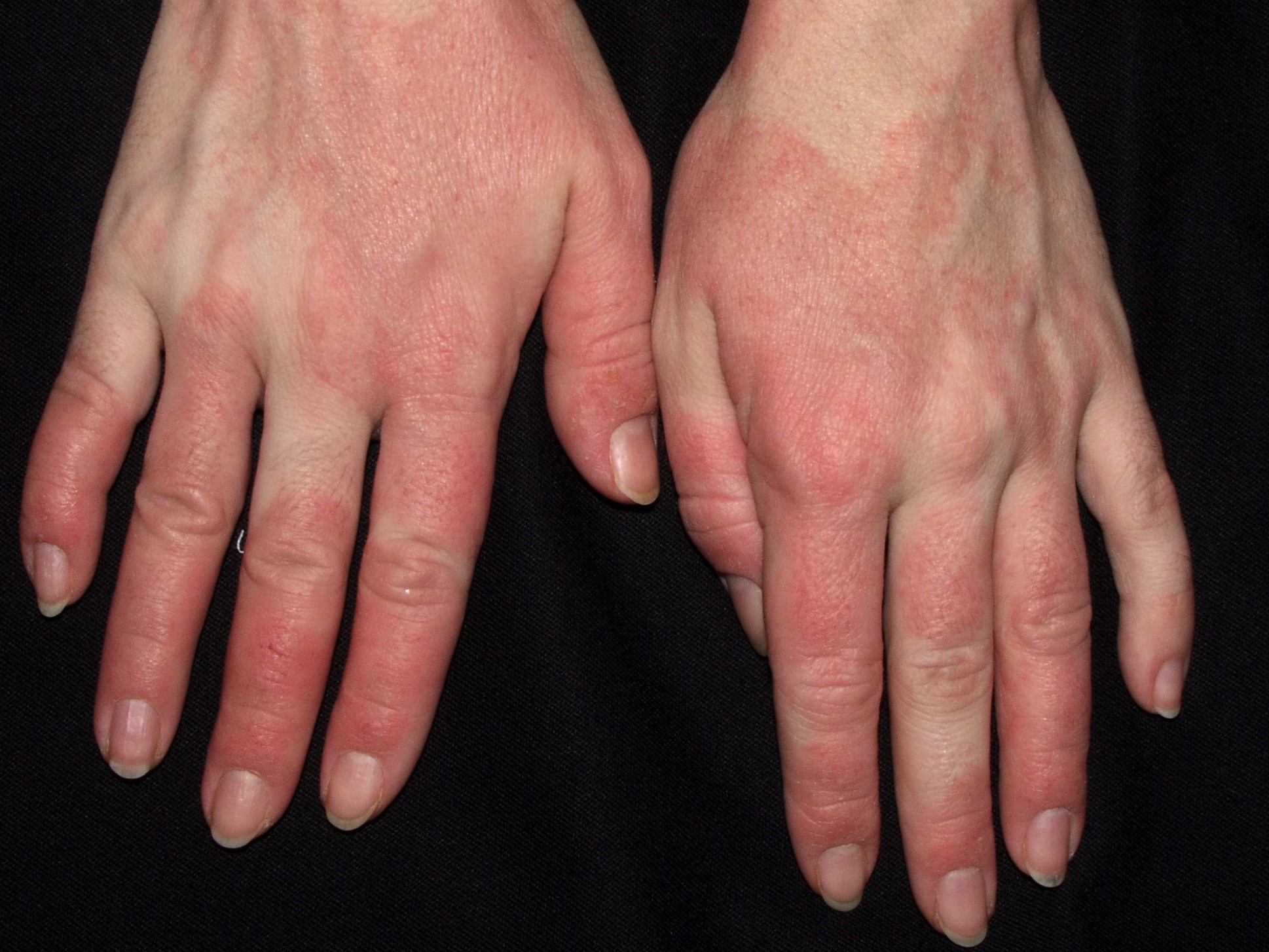 L24 dermatitis irritativa de contacto por agua y frio; placas eritematosas en dorso de manos