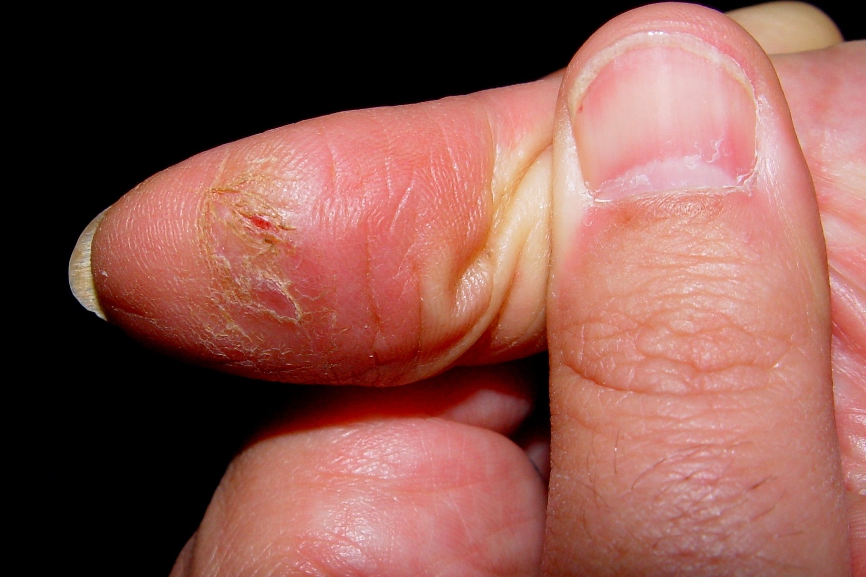 L24 dermatitis irritativa de contacto por trabajos húmedos; pulpitis fisurada
