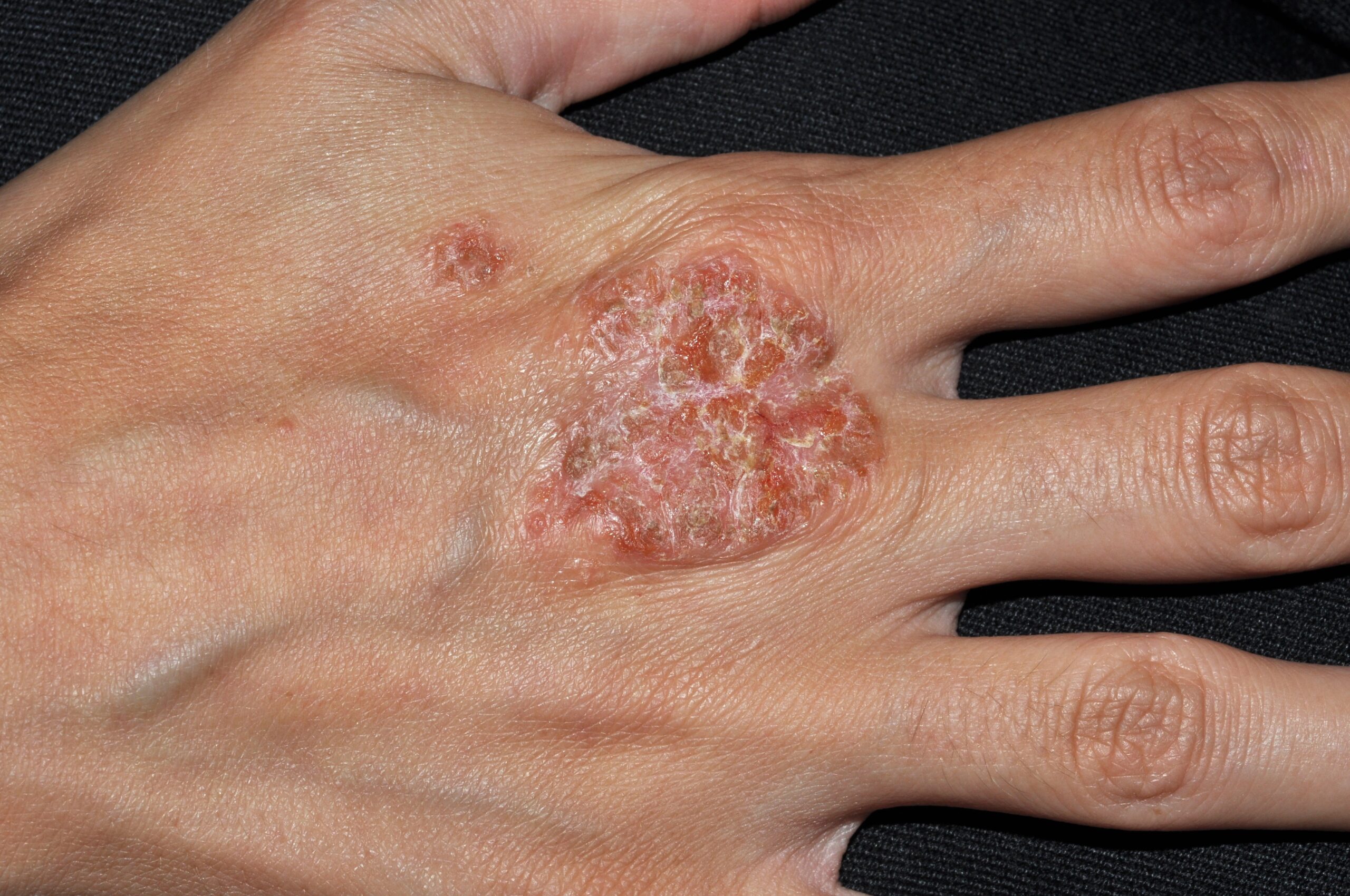 L30.0 Dermatitis numular; eczema numular, placa eccematosa circular con exudación y escamocostras1 (1)