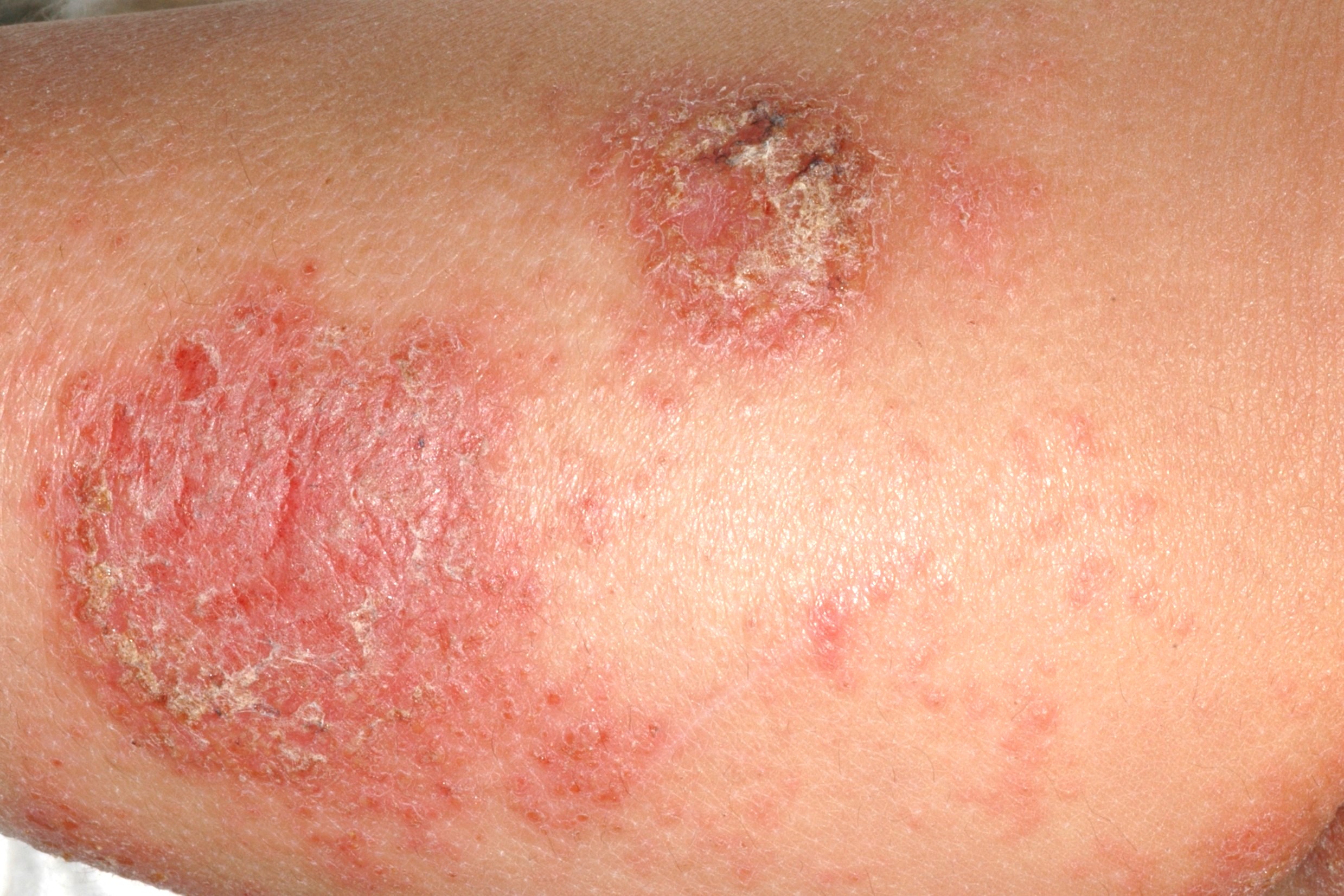 L30.0 Eczema numular; placas eriematoexudativas con escamocostras en extremidades; evolución subaguda (3)