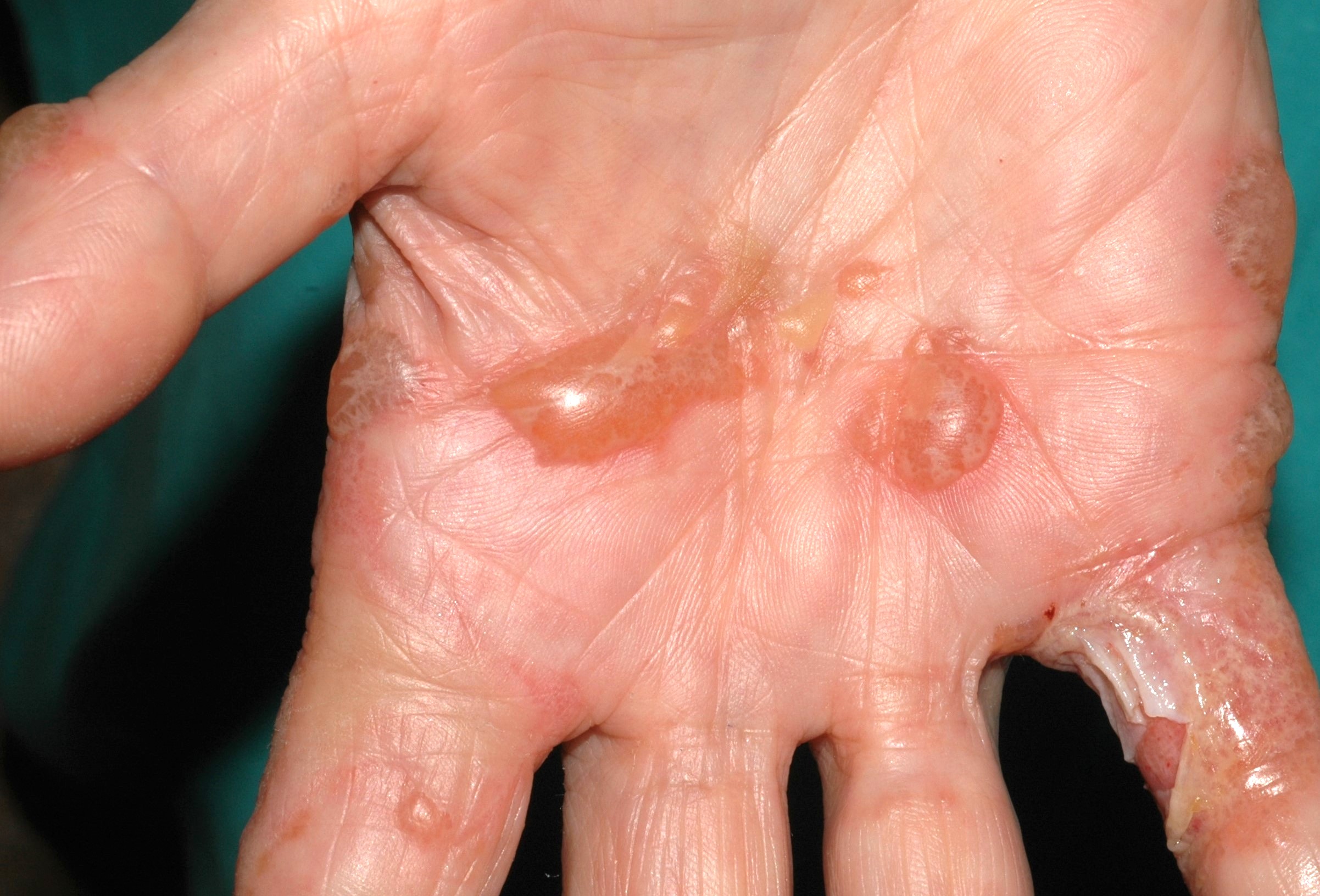 L30.1 Dishidrosis ampollosa de la mano, ampollas multiloculares  (2)
