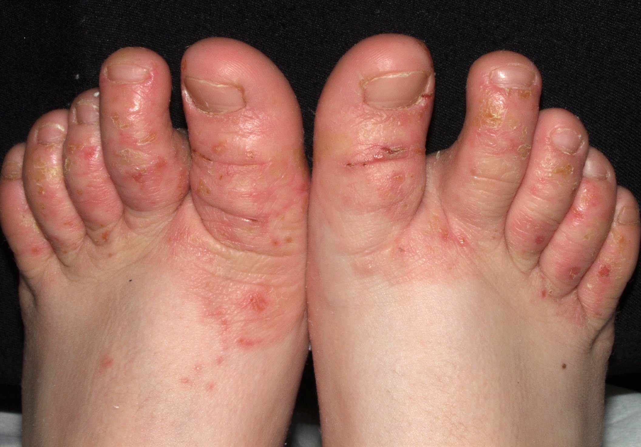 L30.1 Dishidrosis, eczema en fase subaguda, vesículas, erosiones, exudación, descamación y fisuras en los dedos de los pies (1)