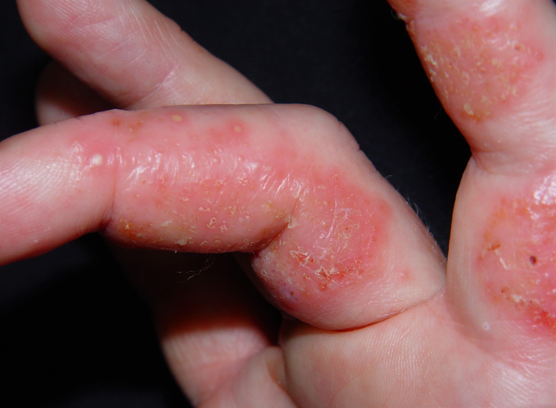 L30.1 Dishidrosis; placas eritematosas con vesículas, alguna pústula, exudación y escamocostras en los dedos de las manos