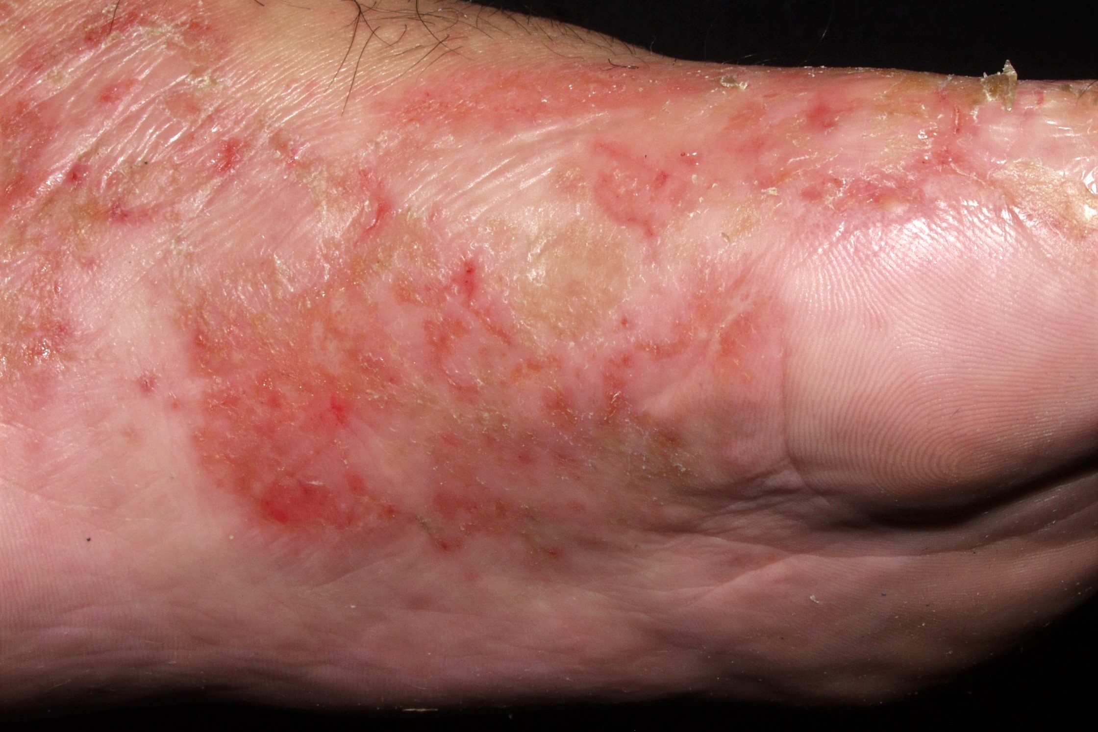 L30.1 Dishidrosis vesiculosa y erosiva crónica y severa de los dedos y las plantas de los pies (2)