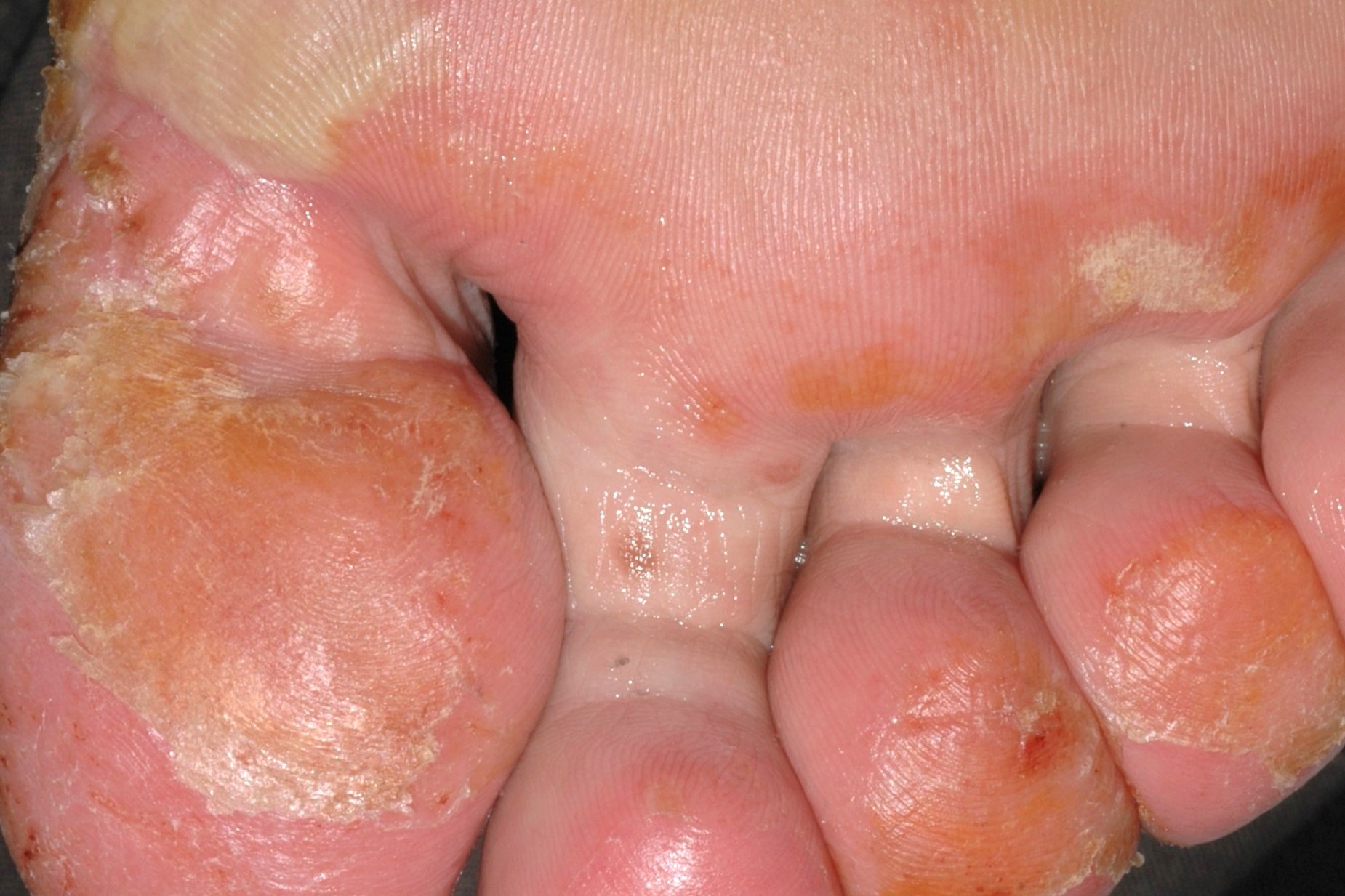 L30.1 Dishidrosis vesiculosa y erosiva crónica y severa de los dedos y las plantas de los pies (3)