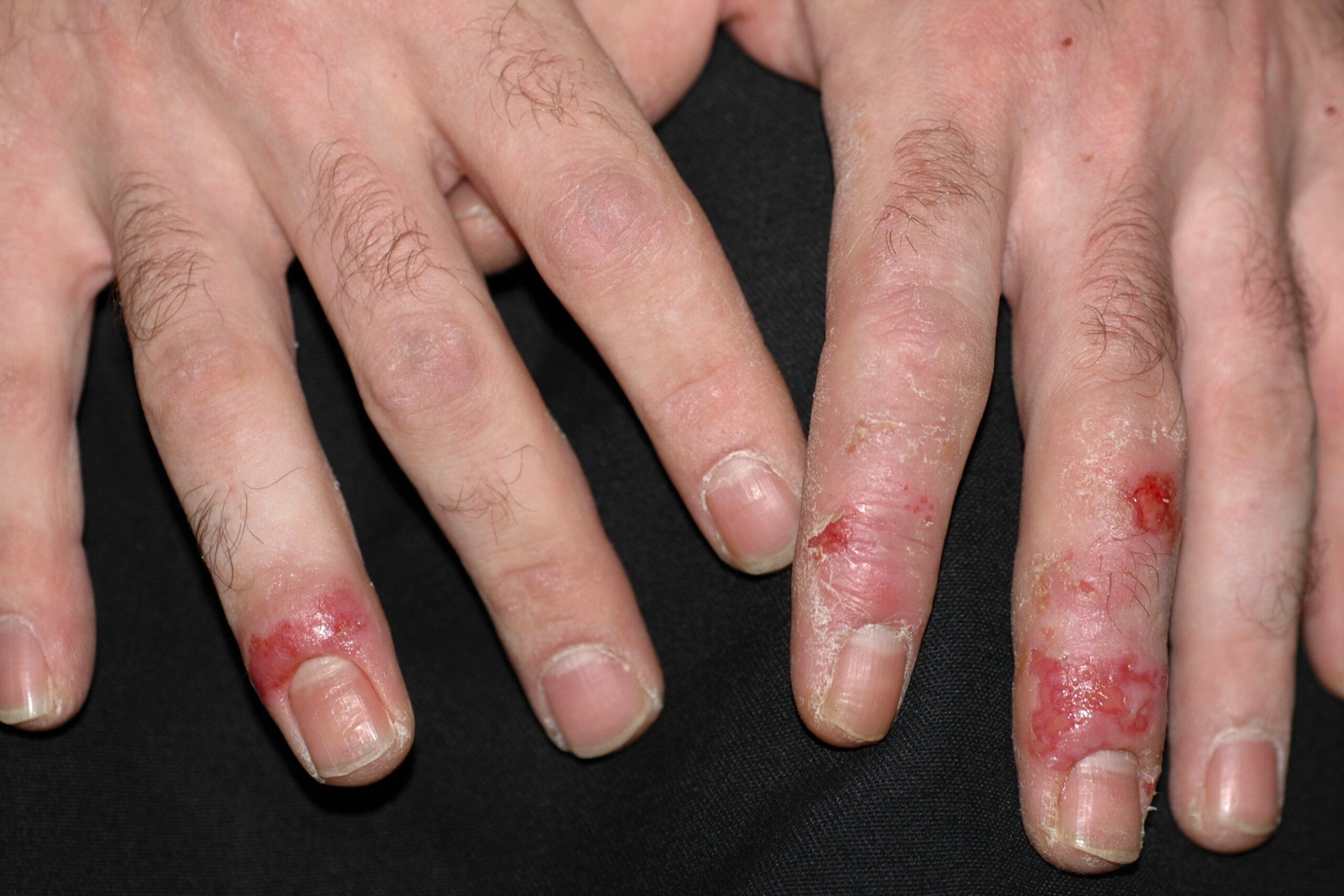 L30.1 Dishidrosis vesiculosa y erosiva de las manos  (1)