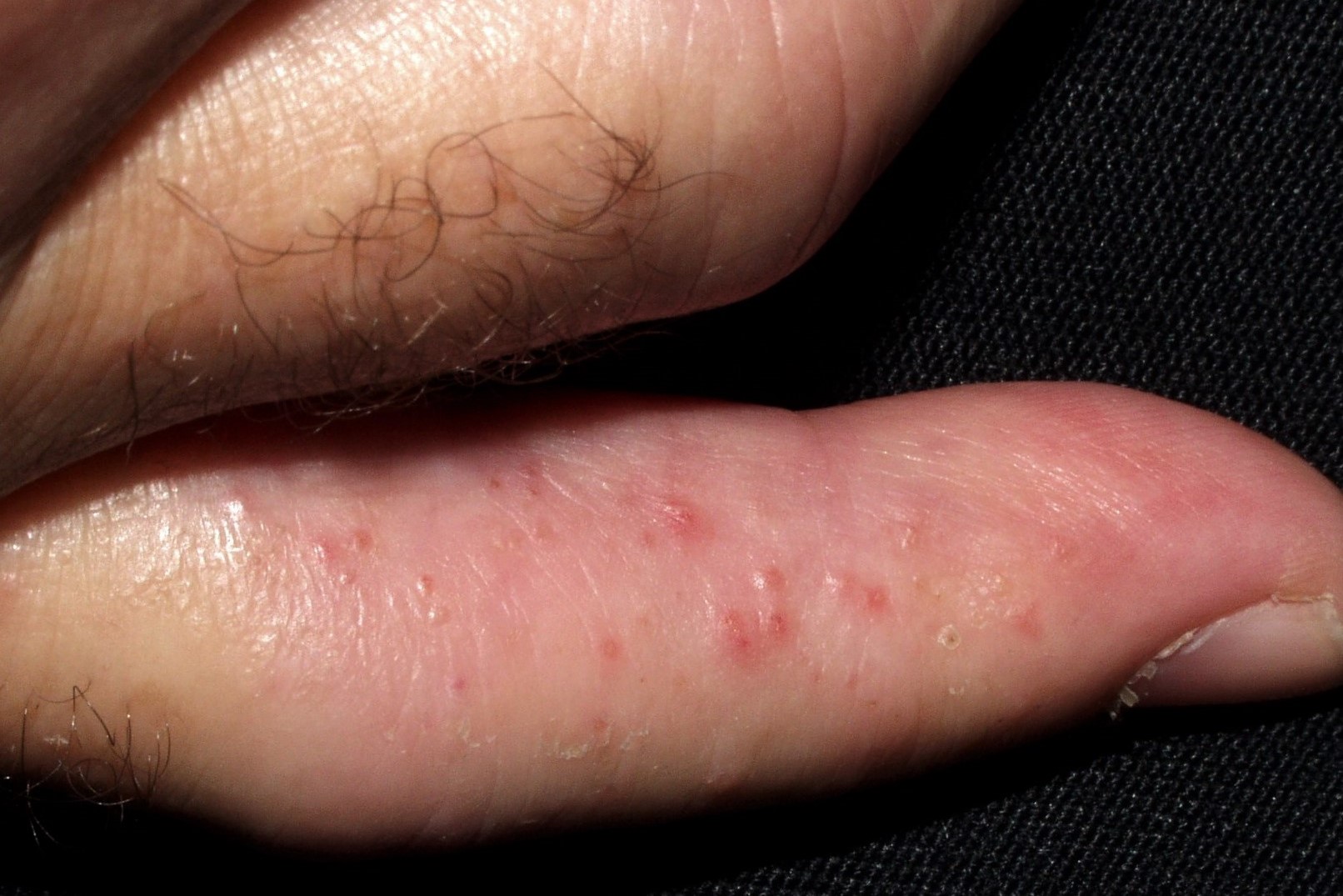 L30.1 Dishidrosis. vesículas en la cara lateral de los dedos de las manos sobre piel aparentemente normal