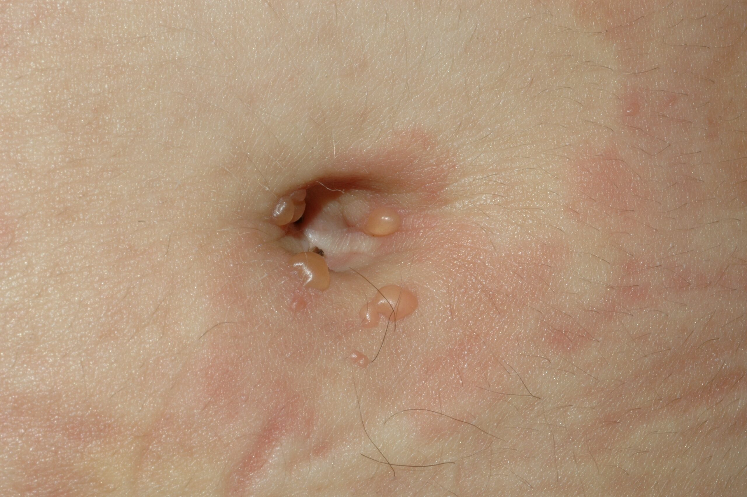 LES ampolloso L32.91; ves&iacute;culas agrupadas alrededor del obligo sobre piel normal y eritematosa en paciente con LES y urticaria vasculitis