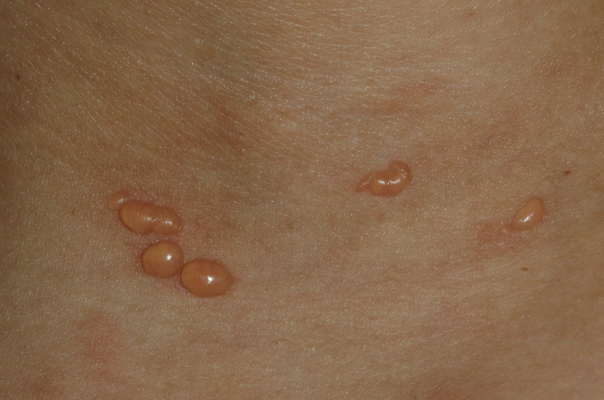 LES ampolloso L32.91; ves&iacute;culas agrupadas en base del cuello sobre piel normal y eritematosa en paciente con LES y urticaria vasculitis (3)