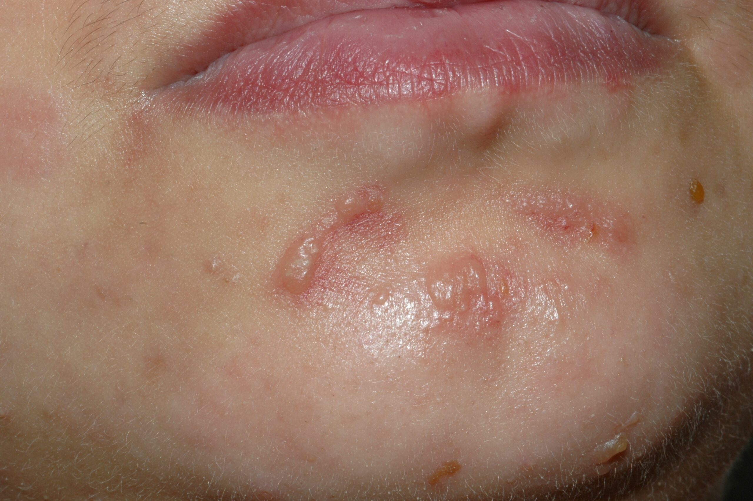 LES ampolloso L32.91; ves&iacute;culas agrupadas en ment&oacute;n sobre piel normal y eritematosa en paciente con LES y urticaria vasculitis (1)