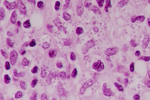 Leishmaniasis B55.1; infiltrado polimorfo con cuerpos de Leishman Donovan en el interior de los macrófagos