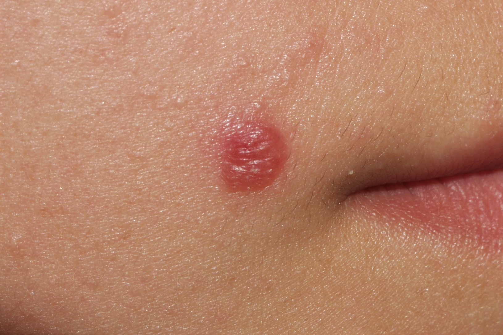 Leishmaniasis cutánea B55.1; boton de oriente en un niño. Pápula eritemato-anaranjada de superficie lisa. Evolución 2 meses. Localización labio superior1 (1)