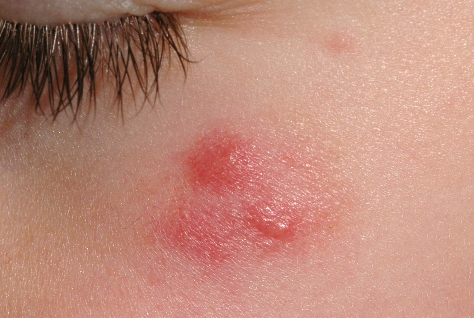 Leishmaniasis cutánea B55.1; boton de oriente en un niño. Placa eritemato-anaranjada, de superficie lisa. Evolución 2 meses. Localización mejilla (1)