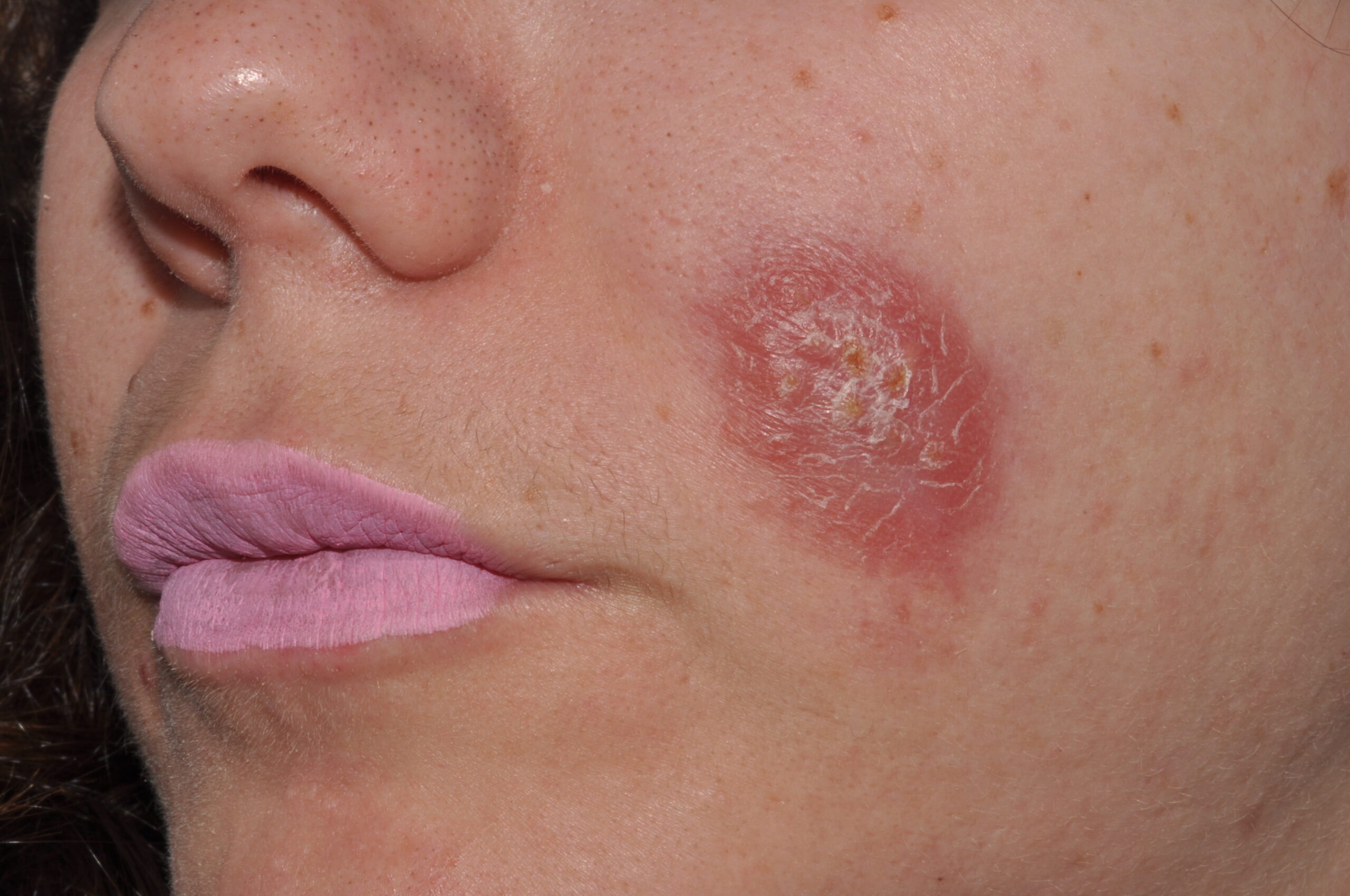 Leishmaniasis cutánea B55.1; boton de oriente, nódulo eritemato-anaranjado de superficie descamativa en la mejilla. Evolución 4 meses.