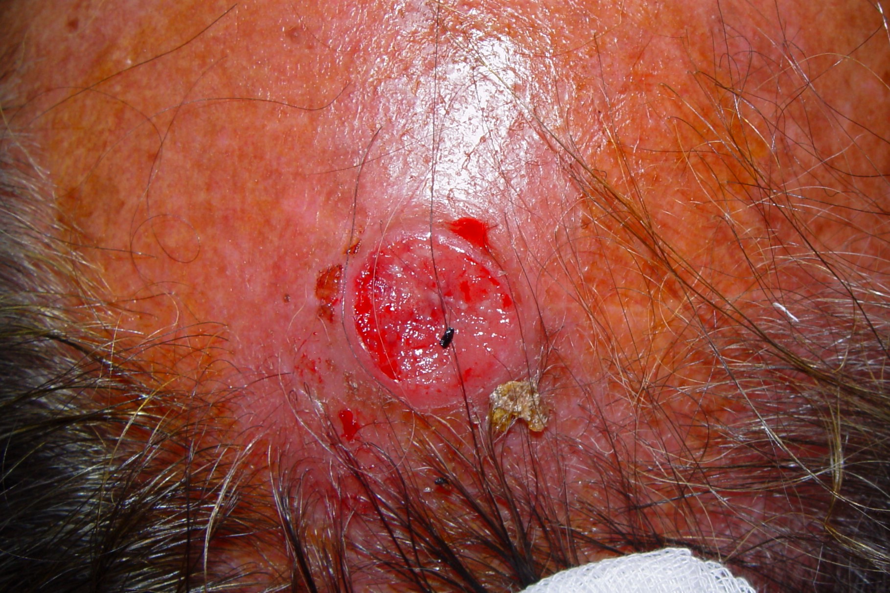 Leishmaniasis cutánea B55.1; boton de oriente, nódulo ulcerado en cuero cabelludo (tras quitar la costra del paciente anterior)